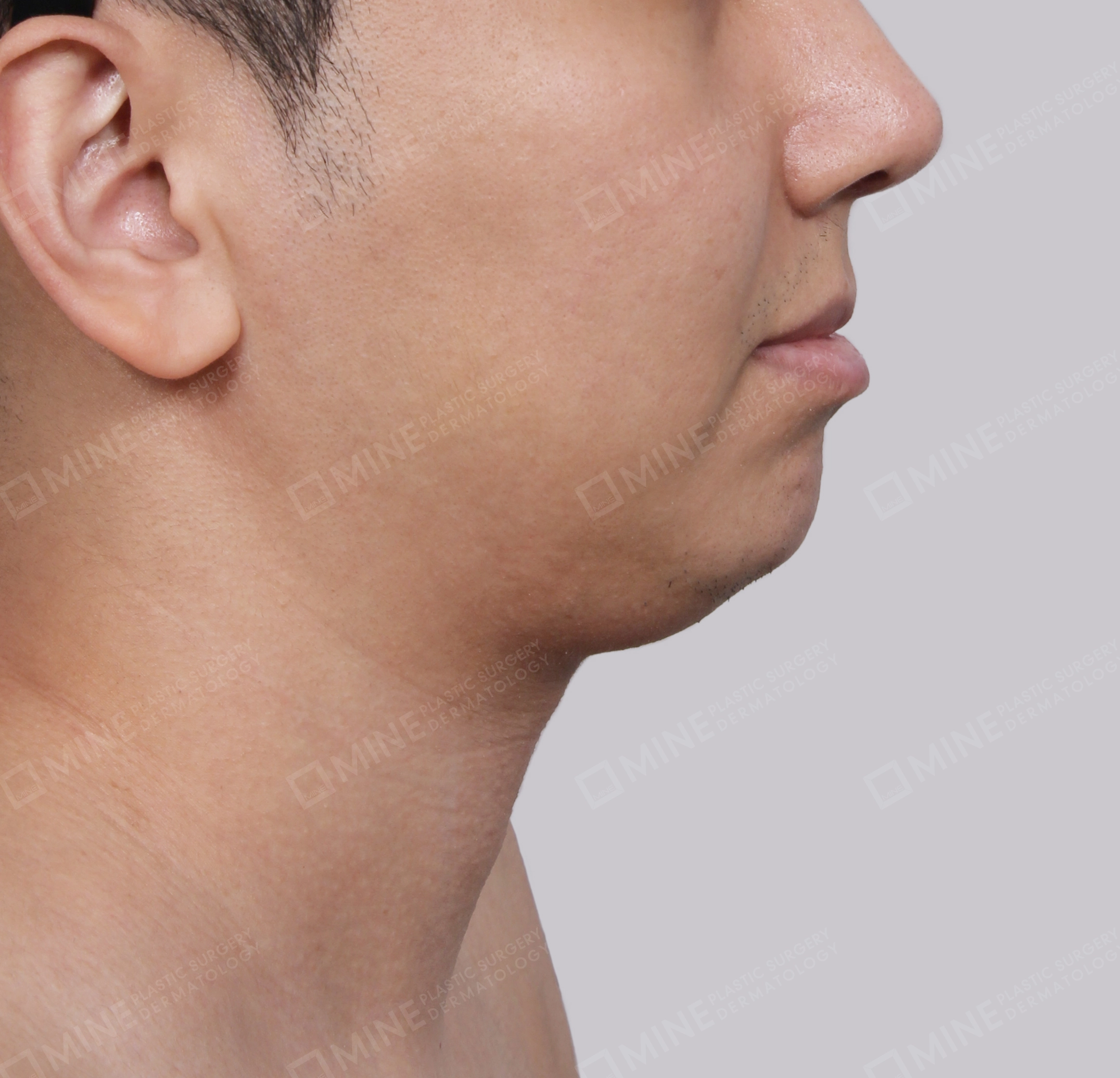 Double Chin-측면-전