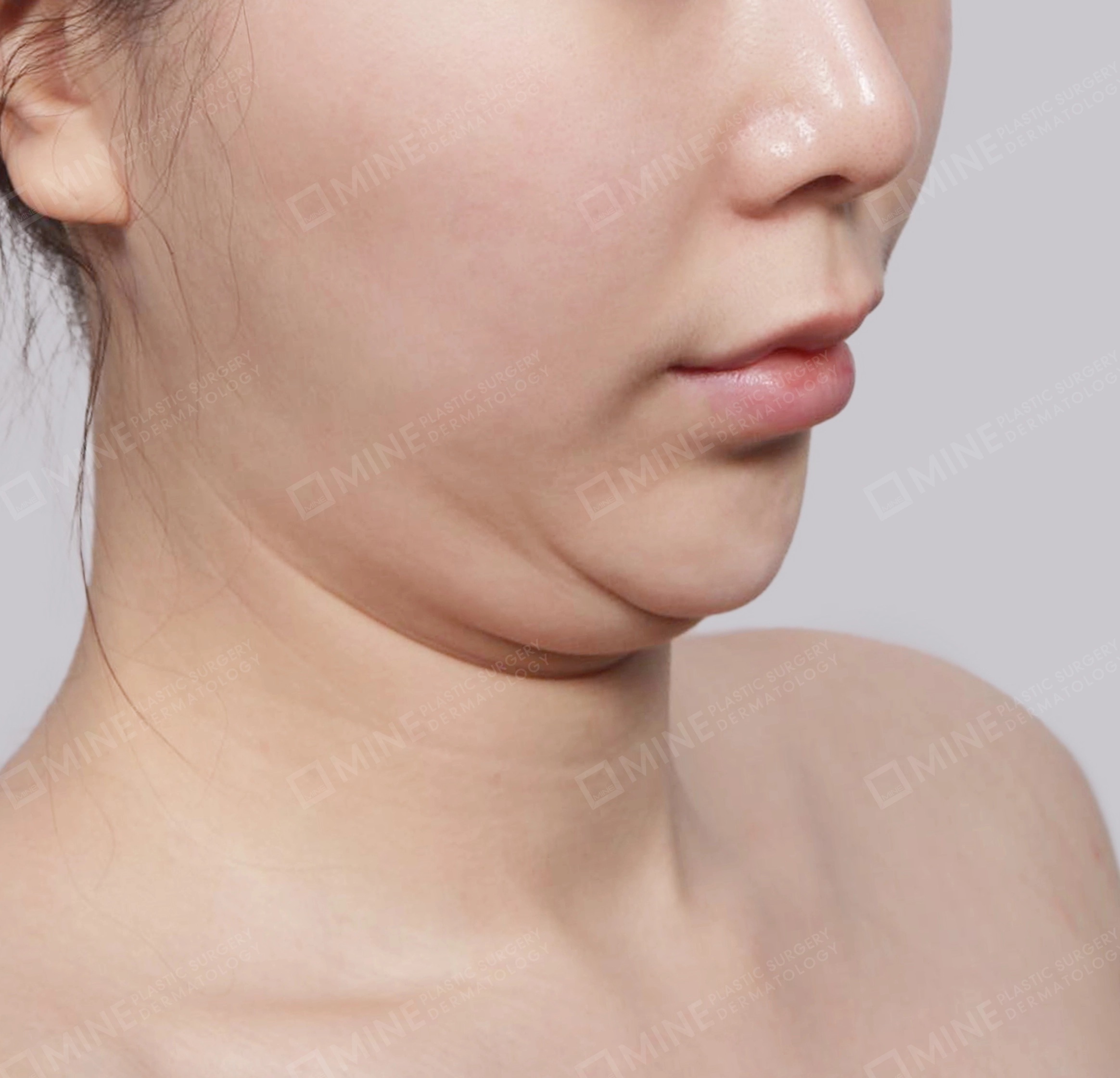 Double Chin-정면-전