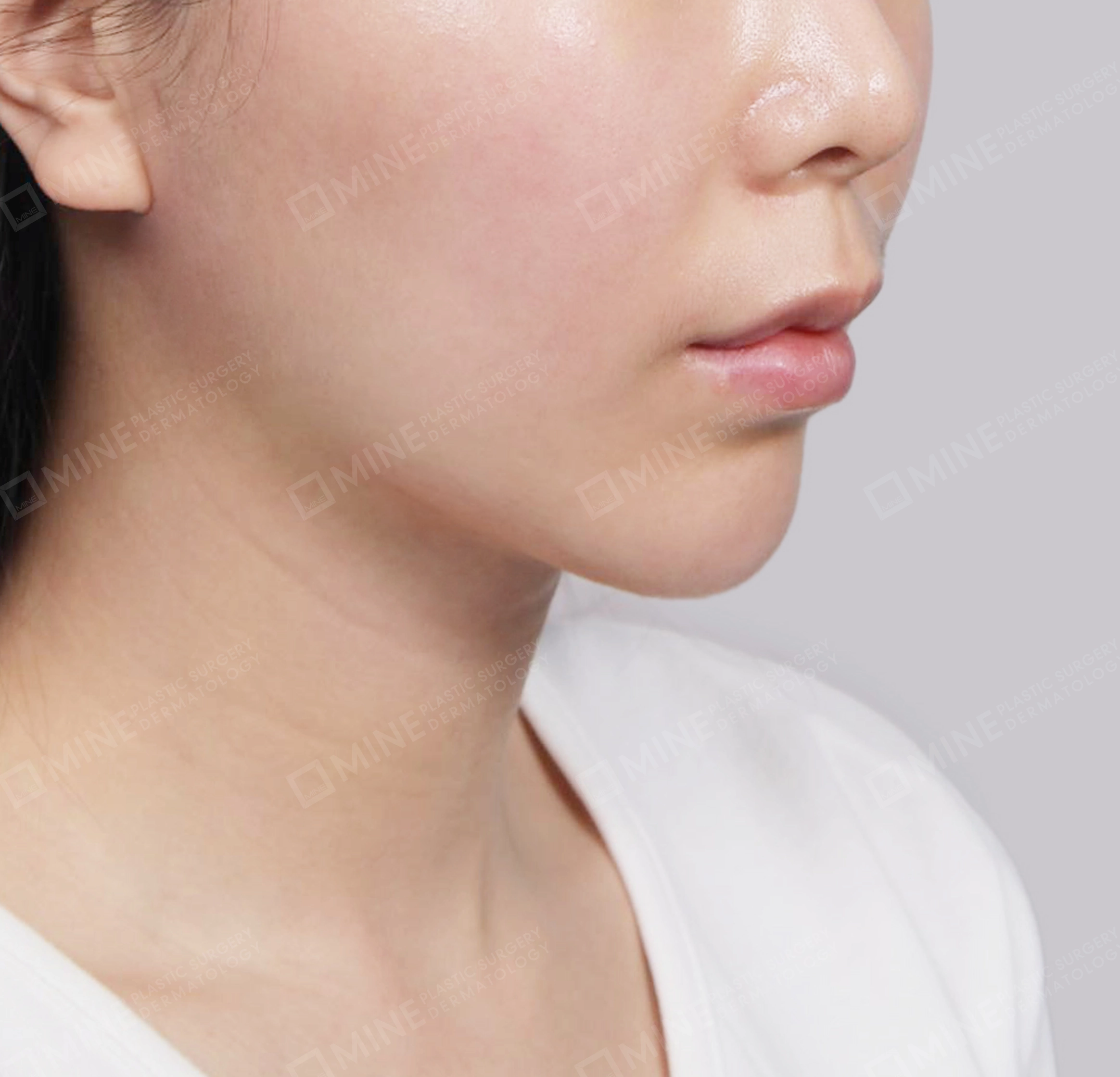 Double Chin-정면-후