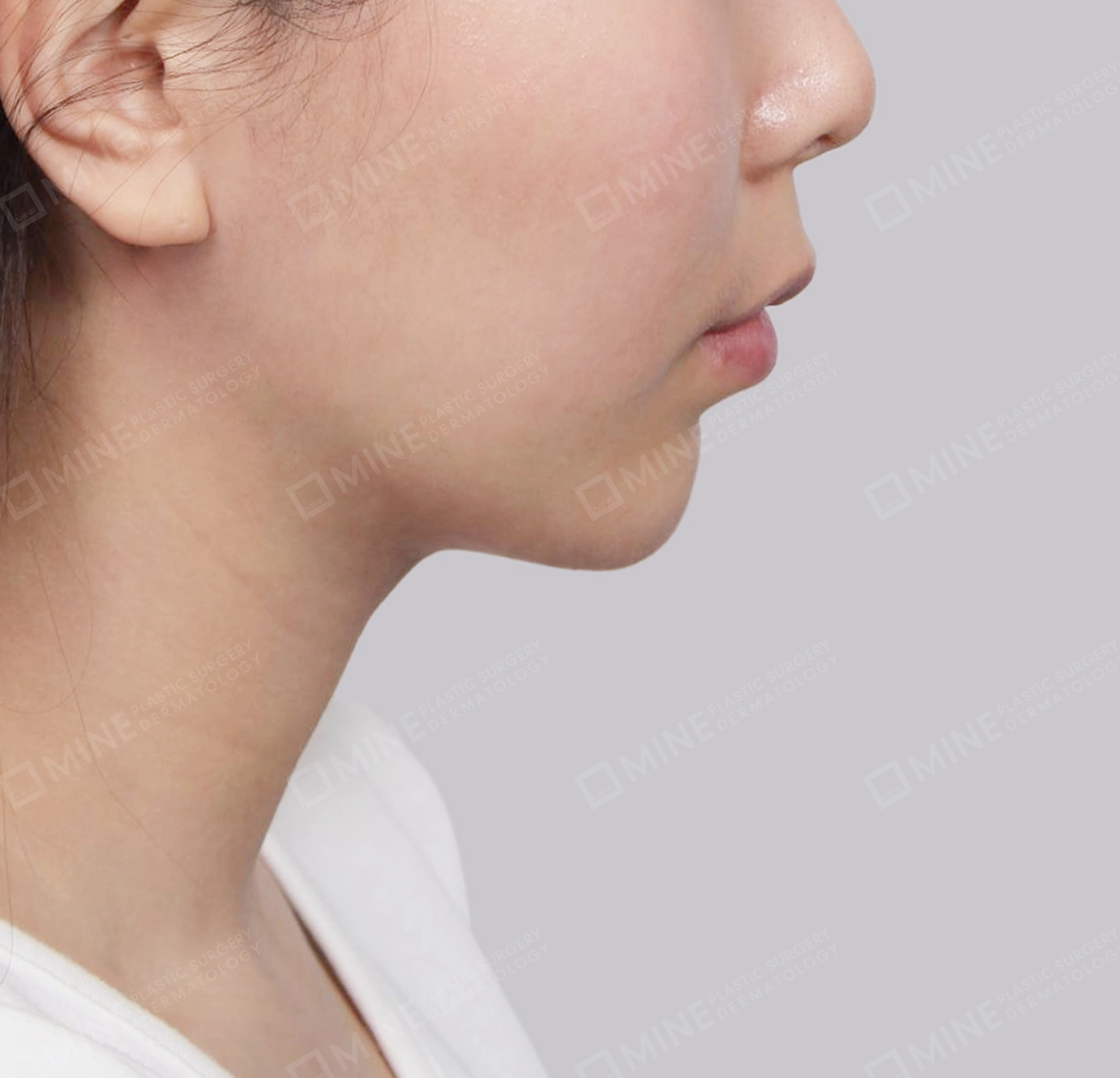 Double Chin-측면-후