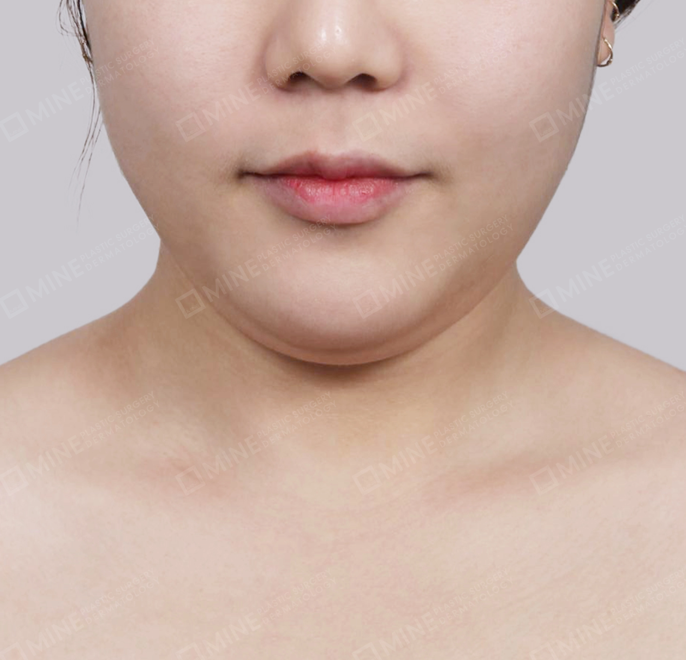 Double Chin-정면-전