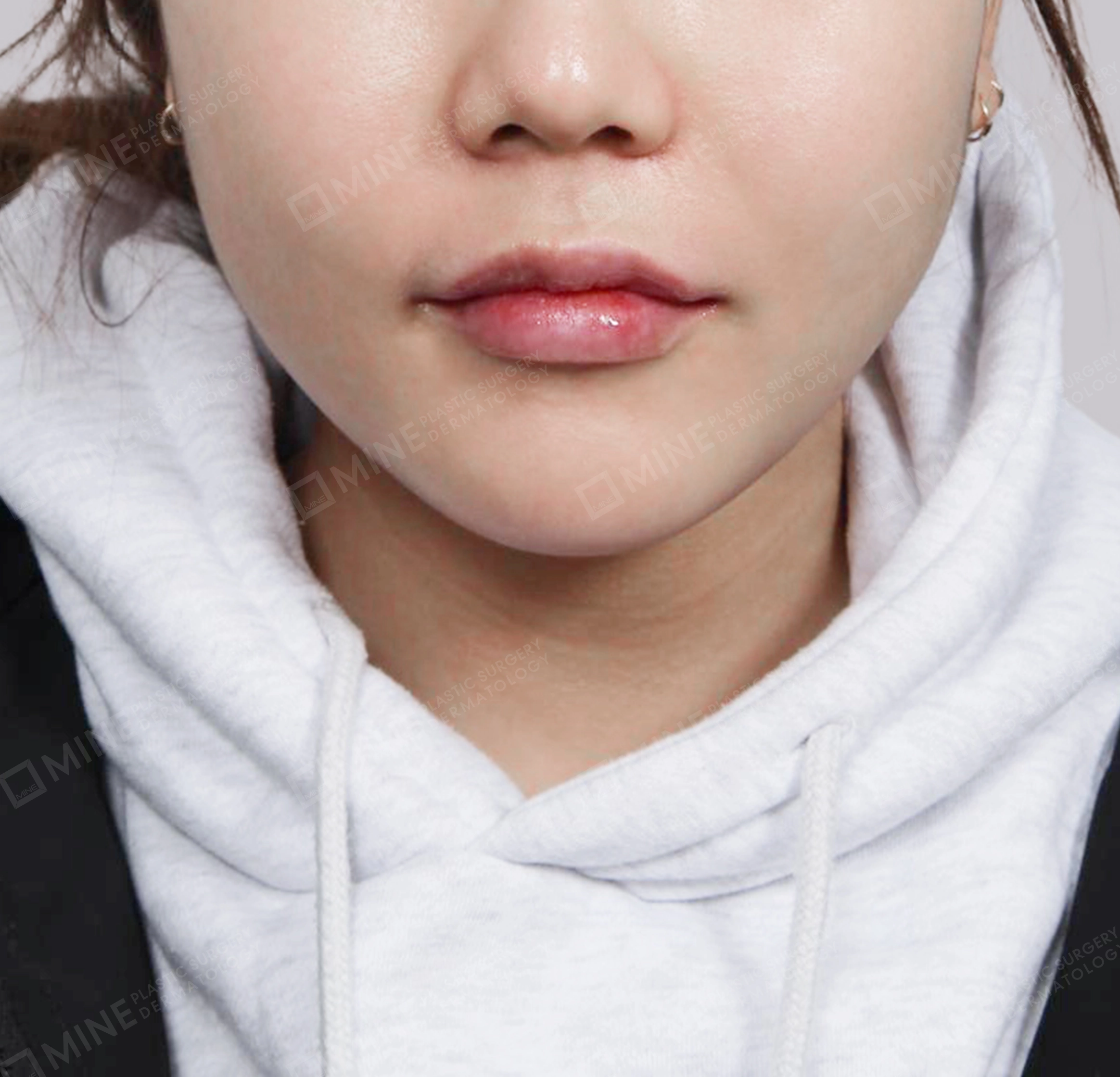 Double Chin-정면-후