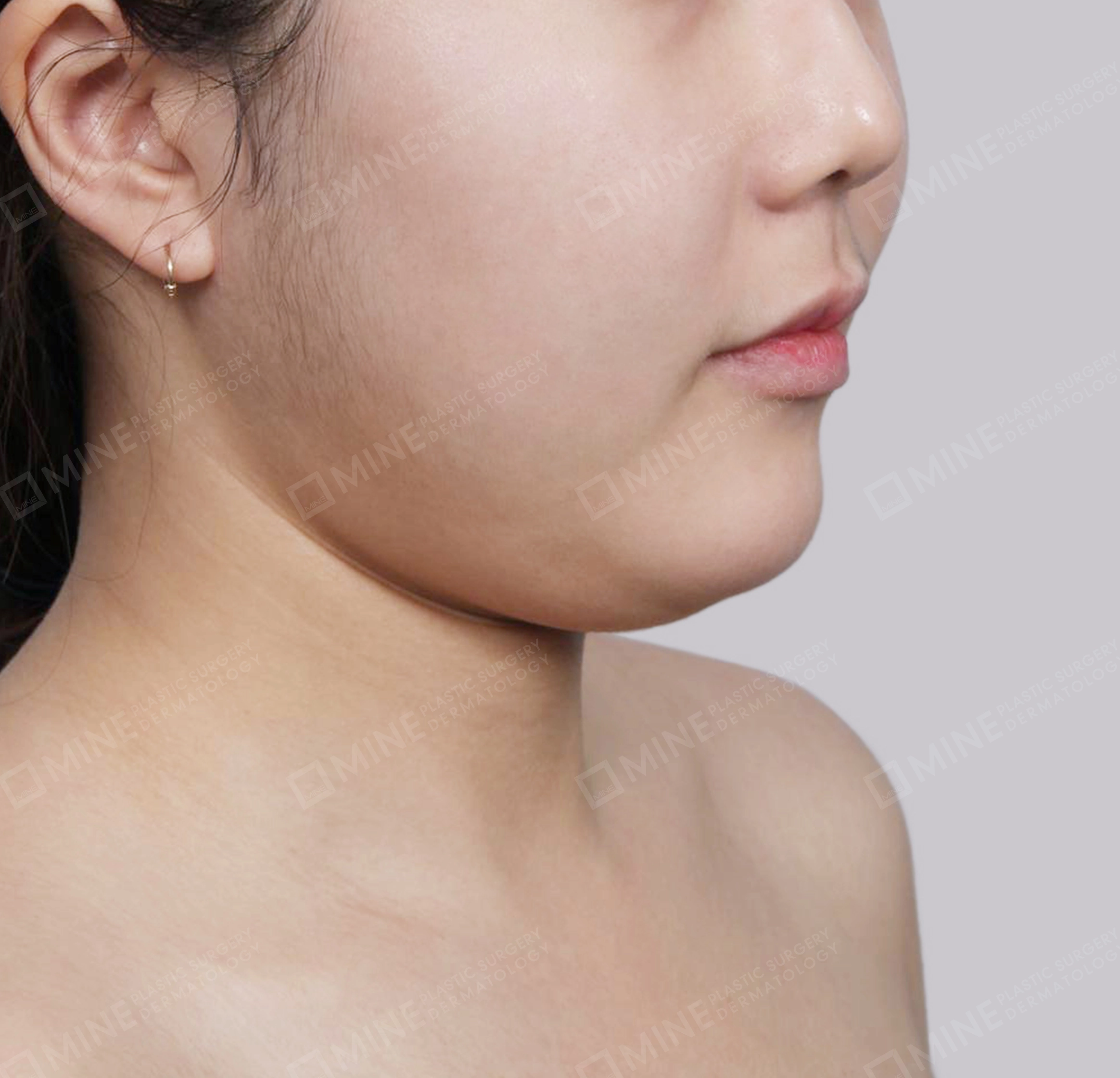 Double Chin-45도-전