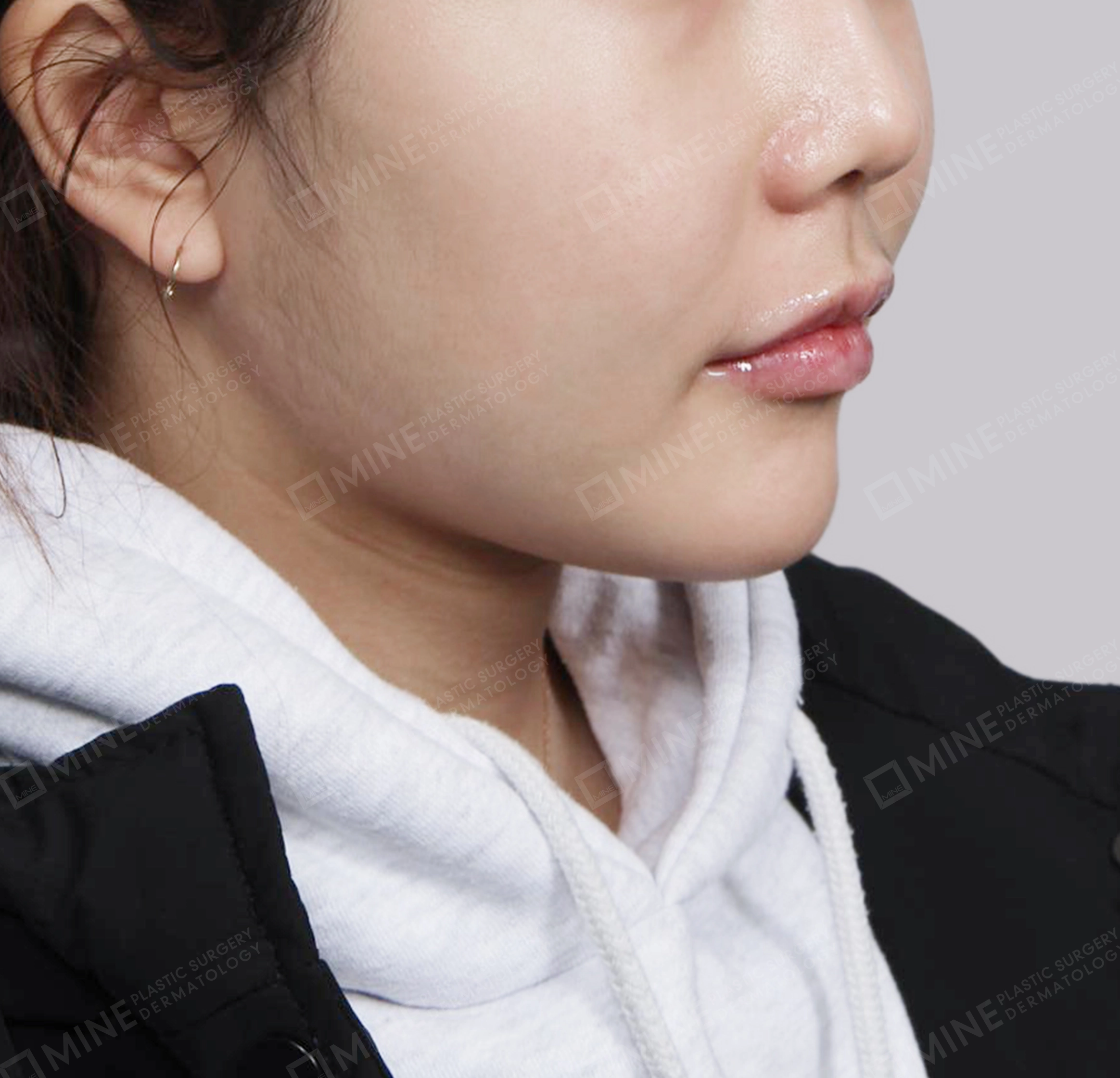 Double Chin-45도-후