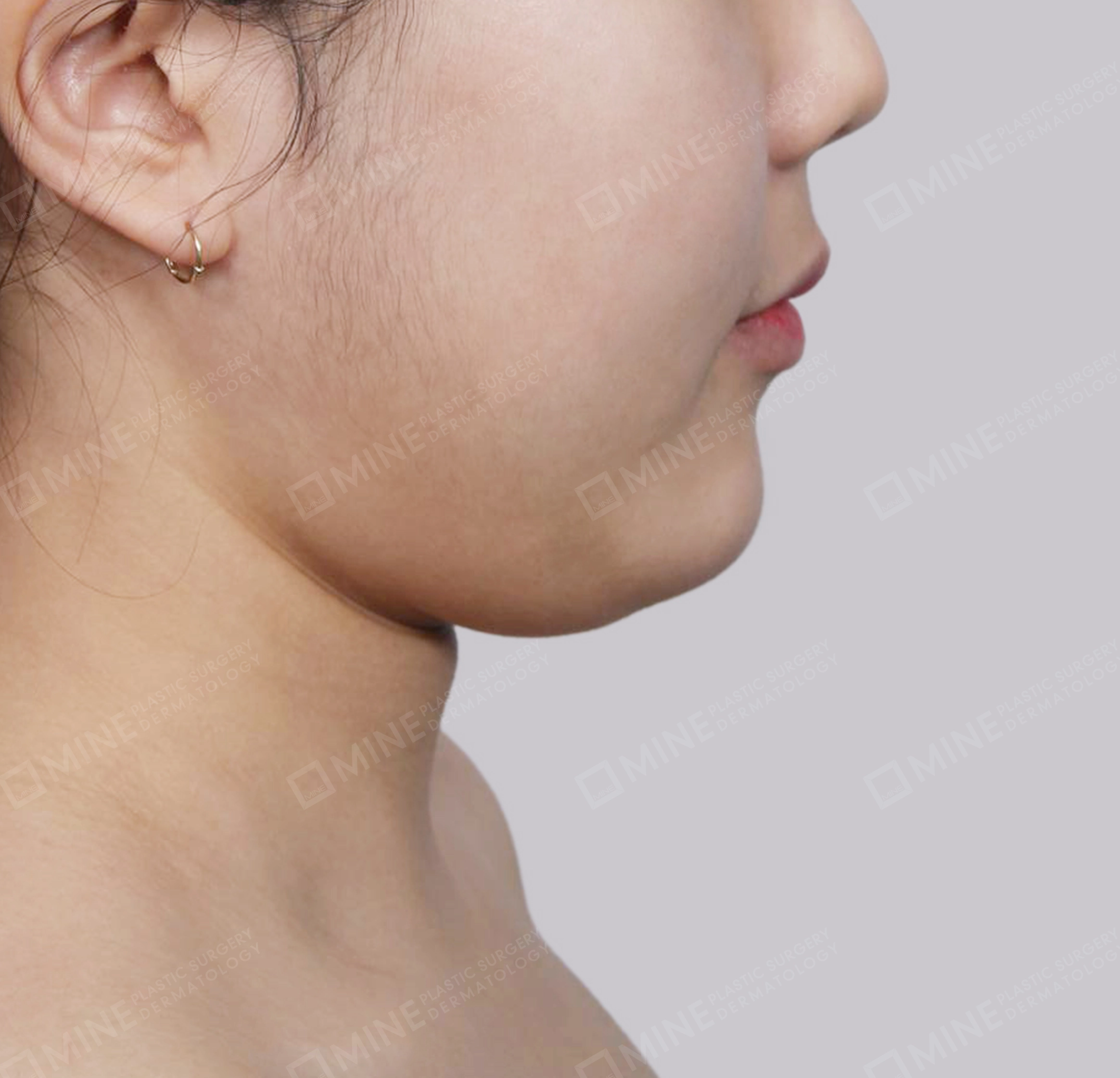 Double Chin-측면-전