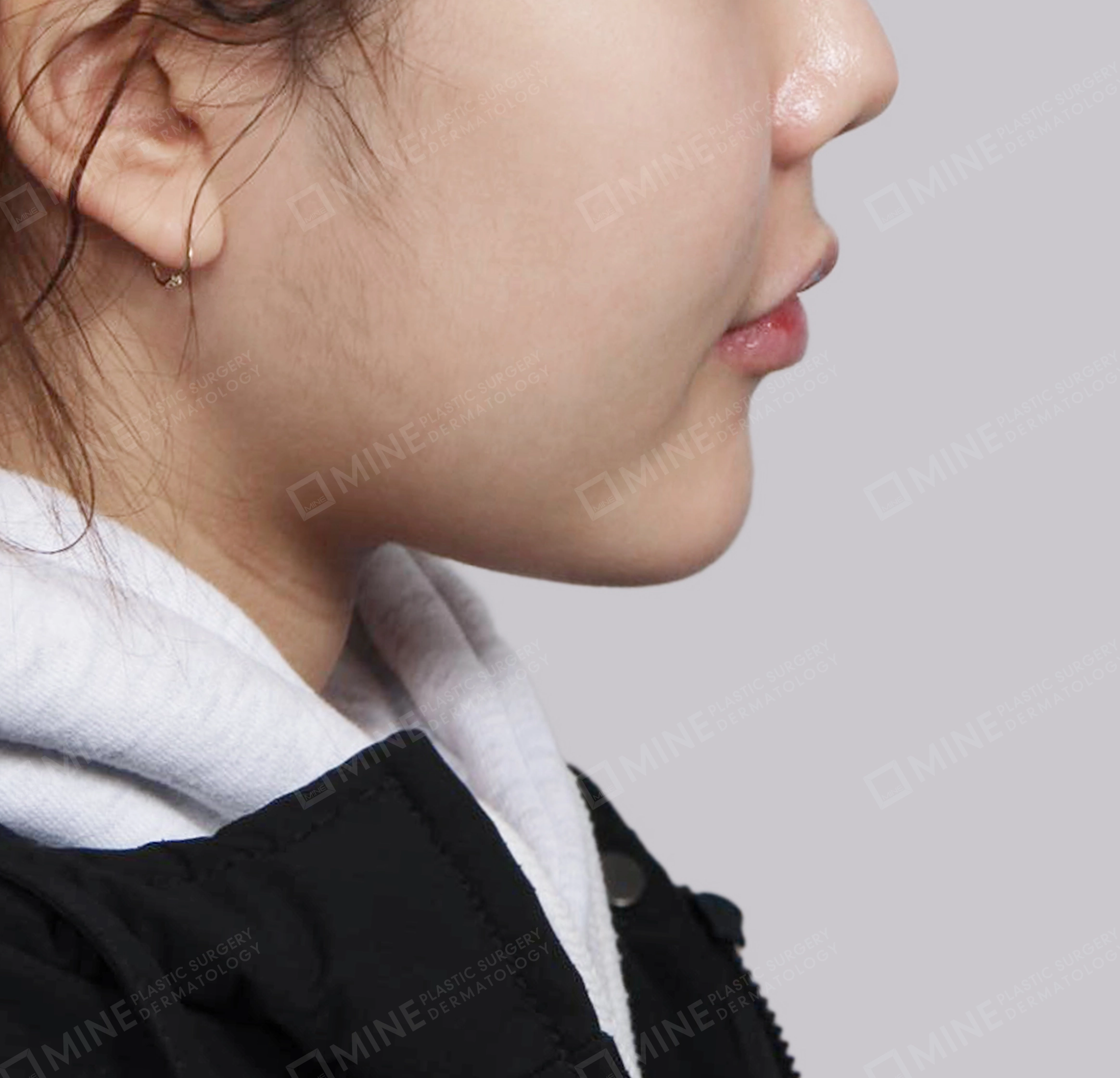 Double Chin-측면-후