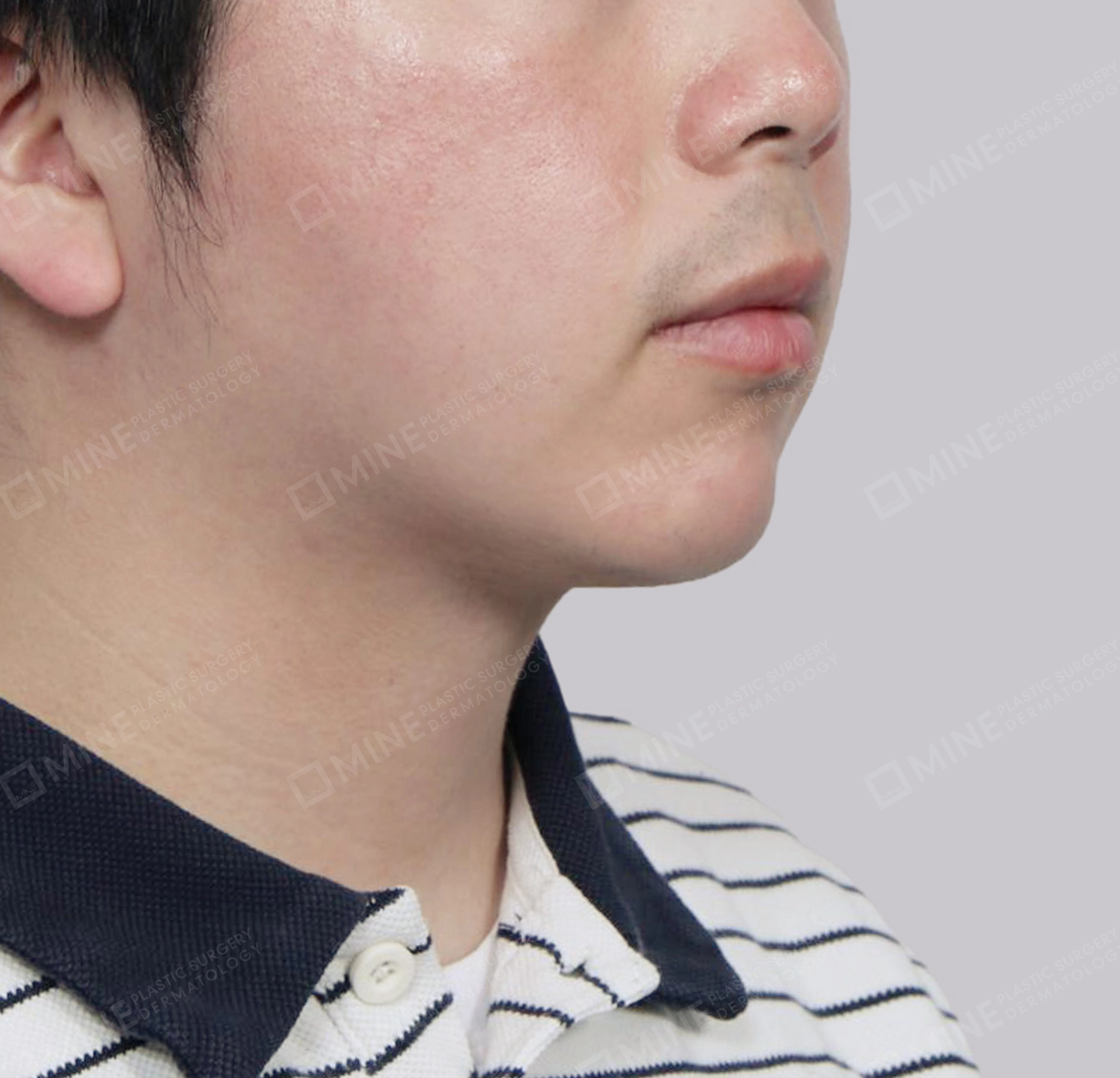 Double Chin-정면-후