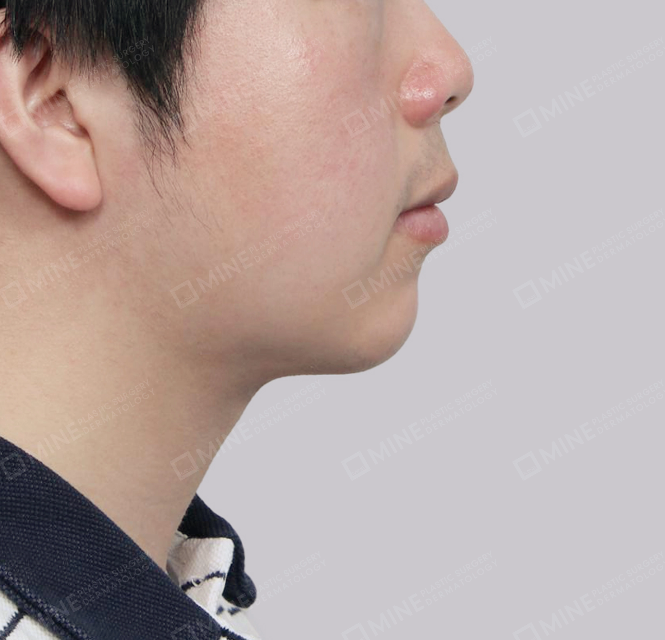 Double Chin-측면-후