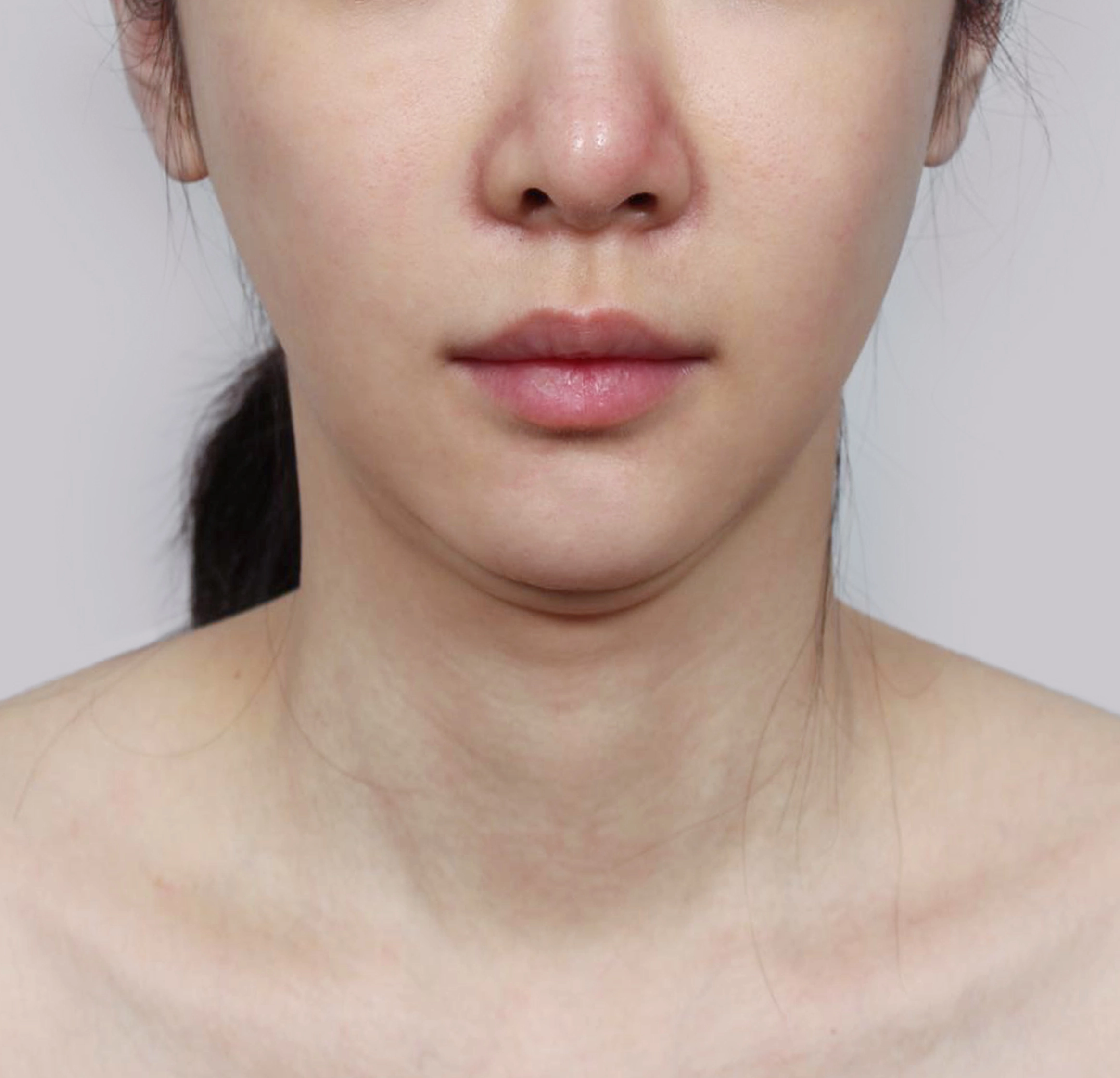 Mini Face Lift-정면-전