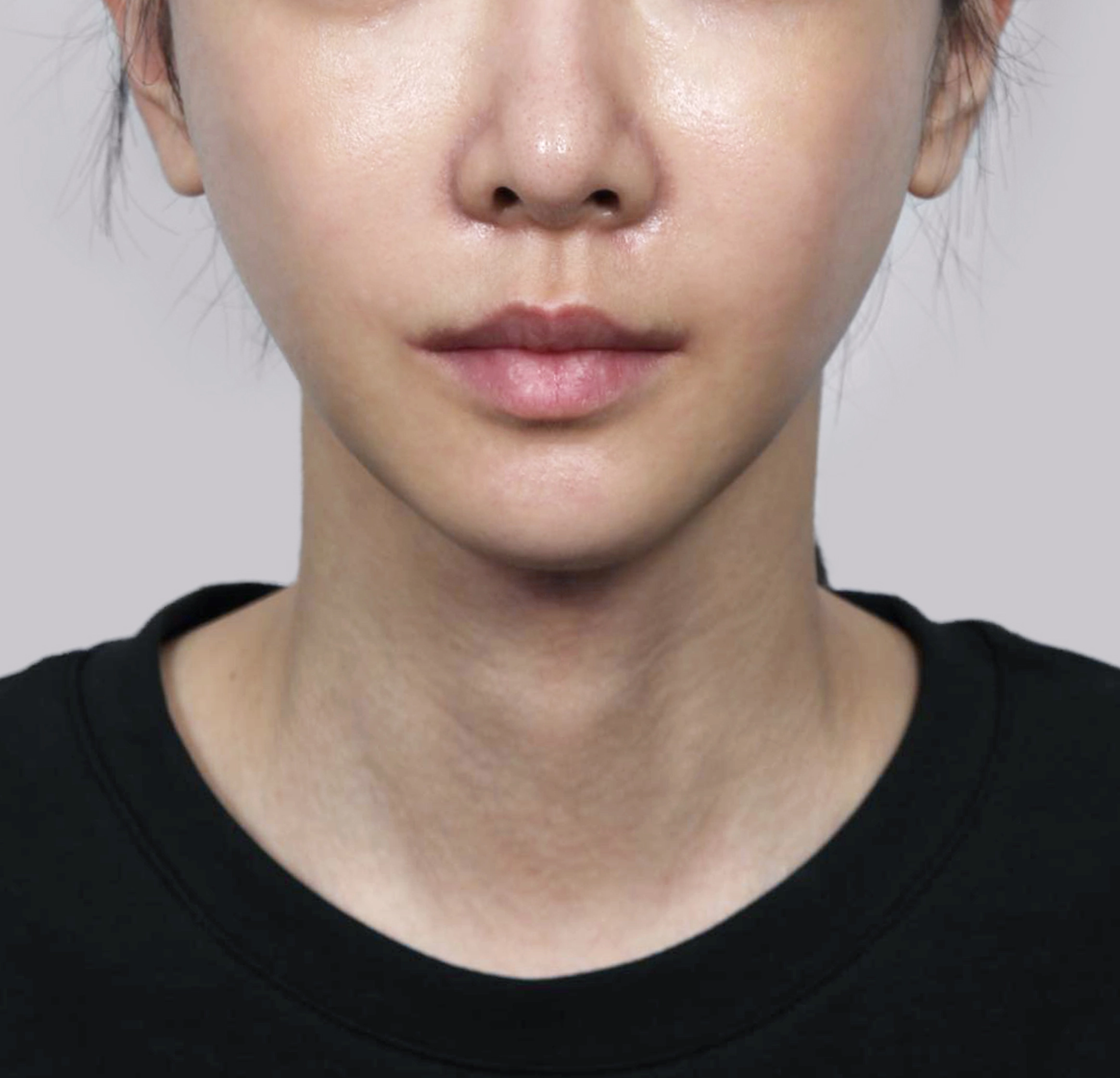 Mini Face Lift-정면-후