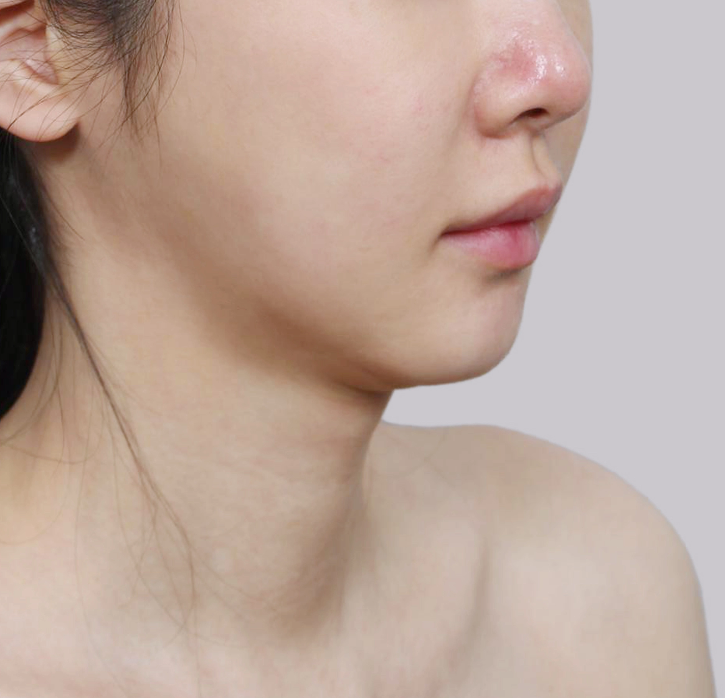 Mini Face Lift-45도-전