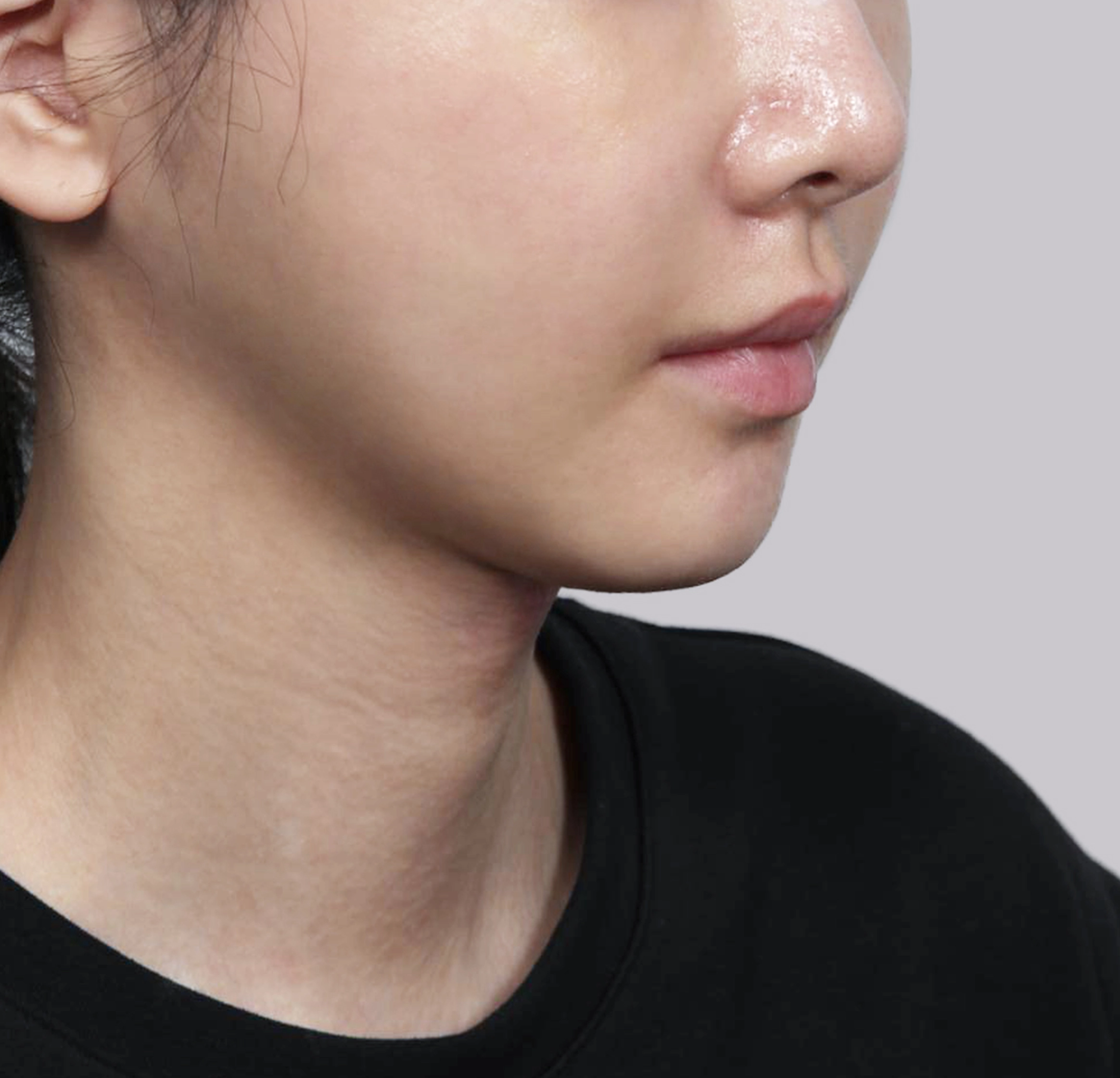 Mini Face Lift-45도-후