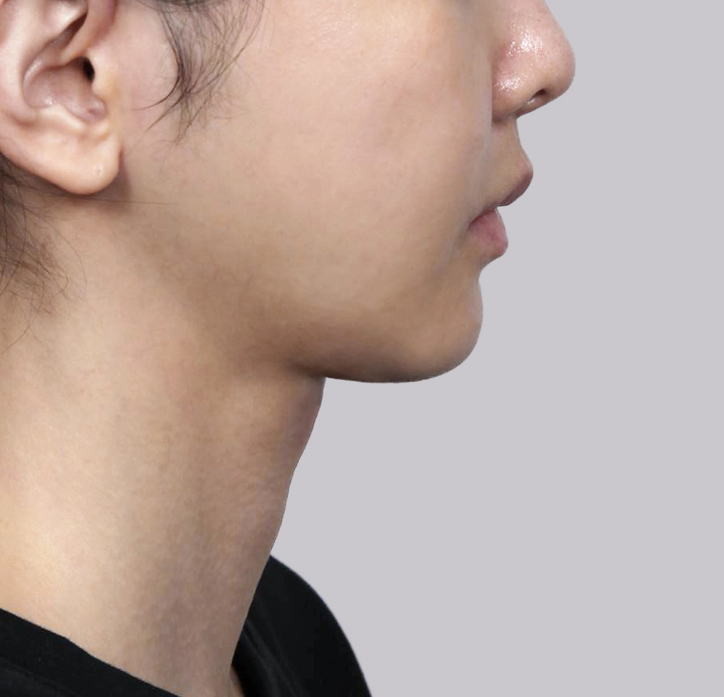 Mini Face Lift-측면-전