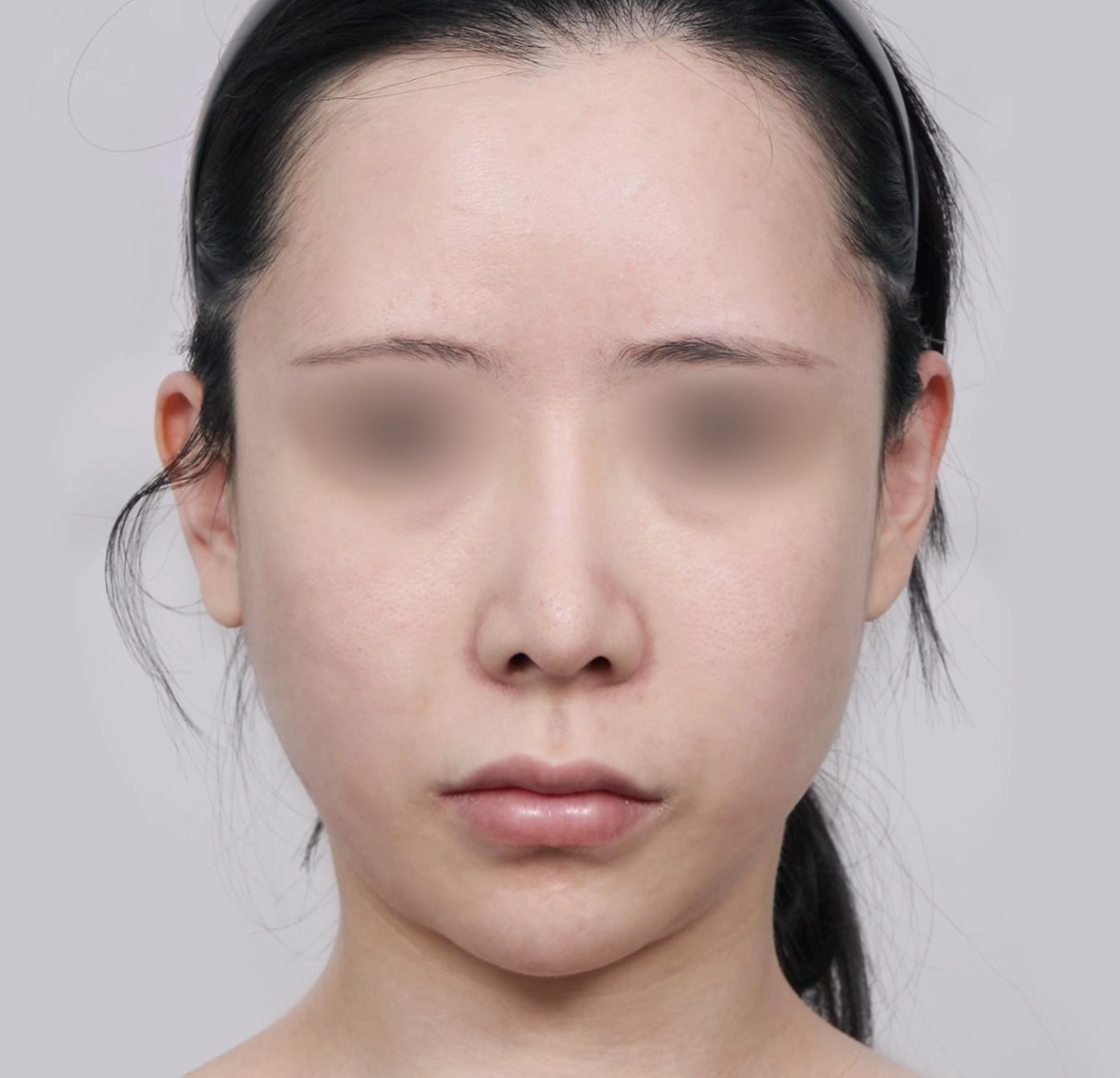 Mini Face Lift-정면-전