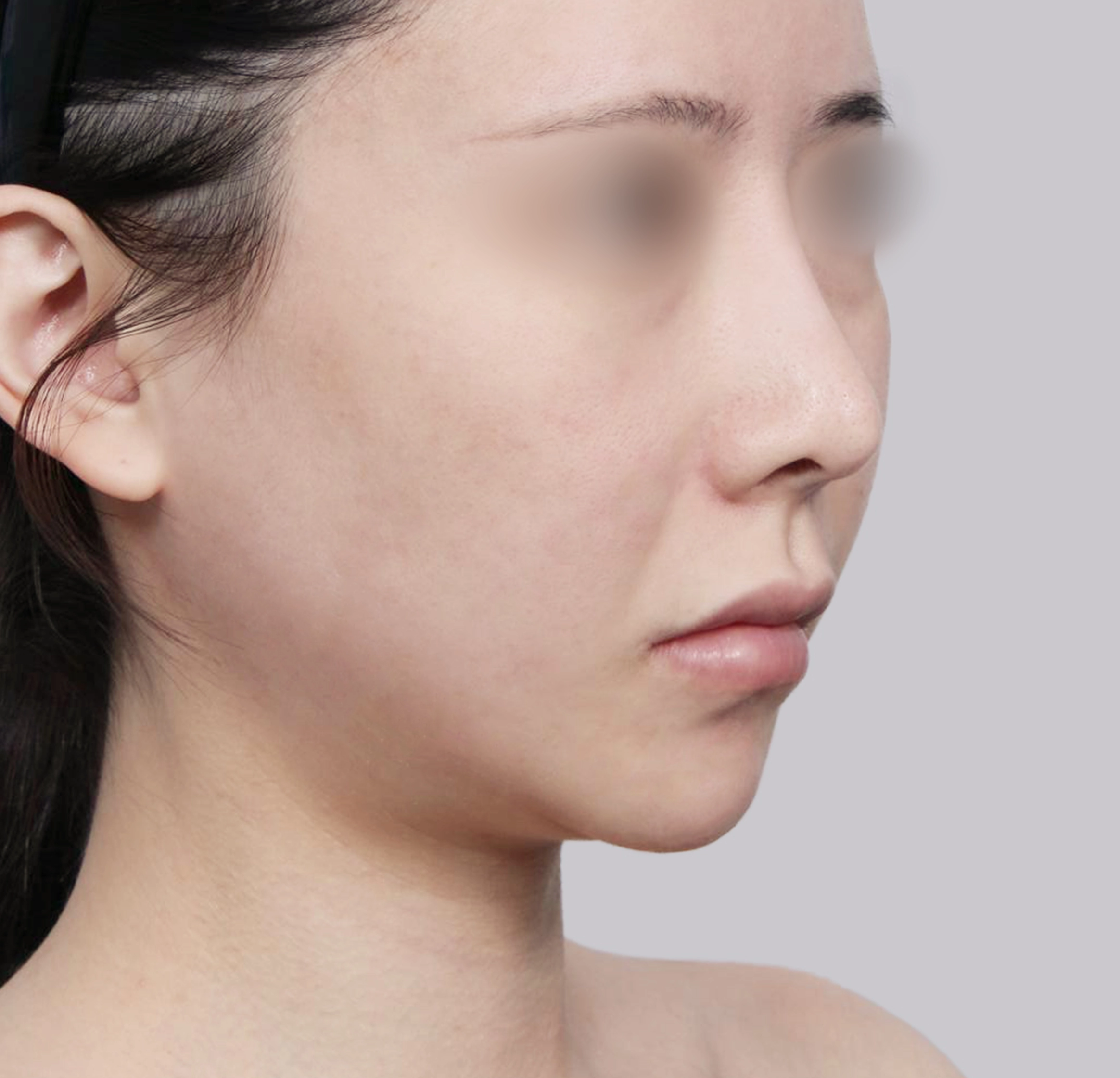 Mini Face Lift-45도-전