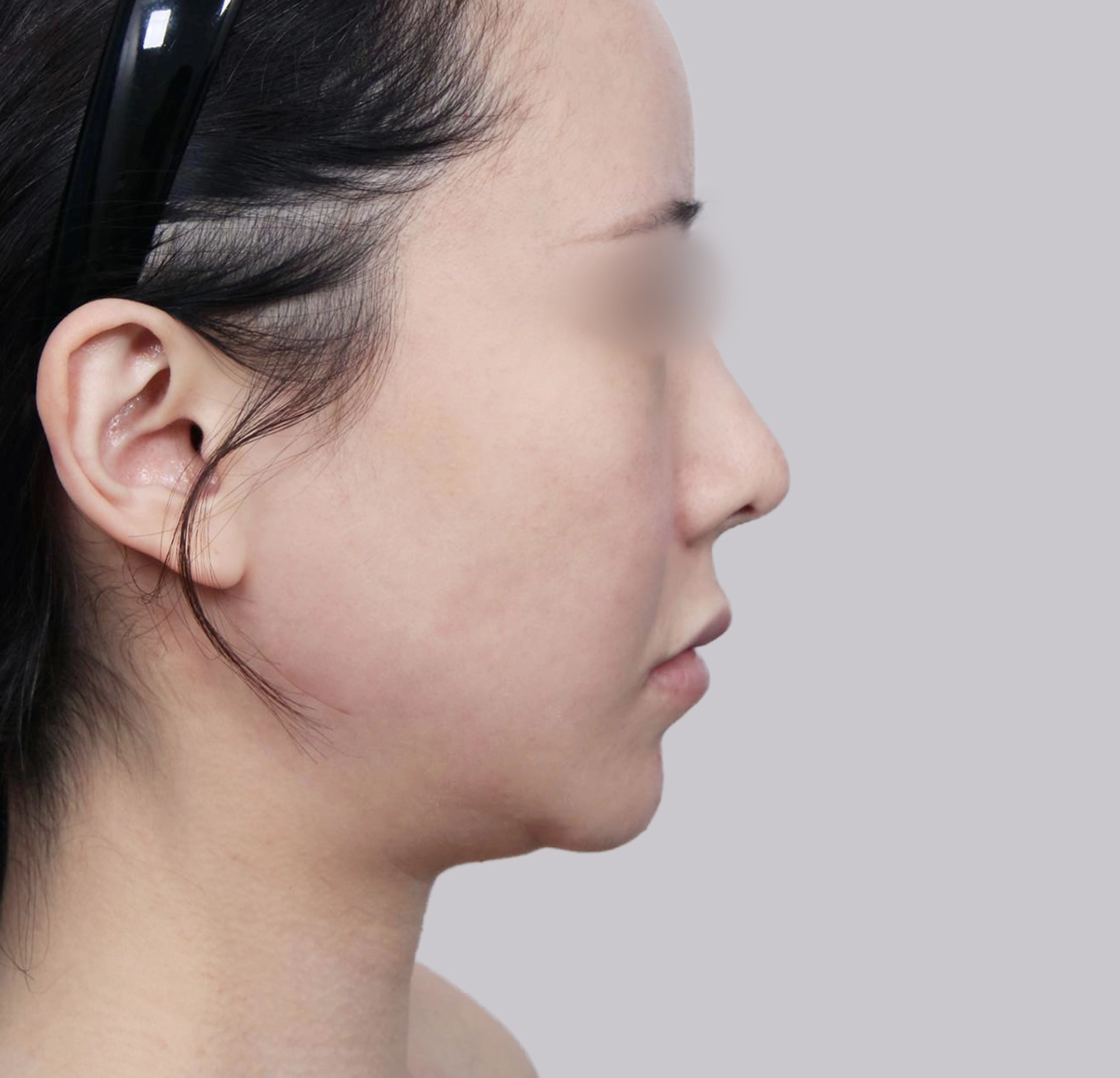 Mini Face Lift-측면-전