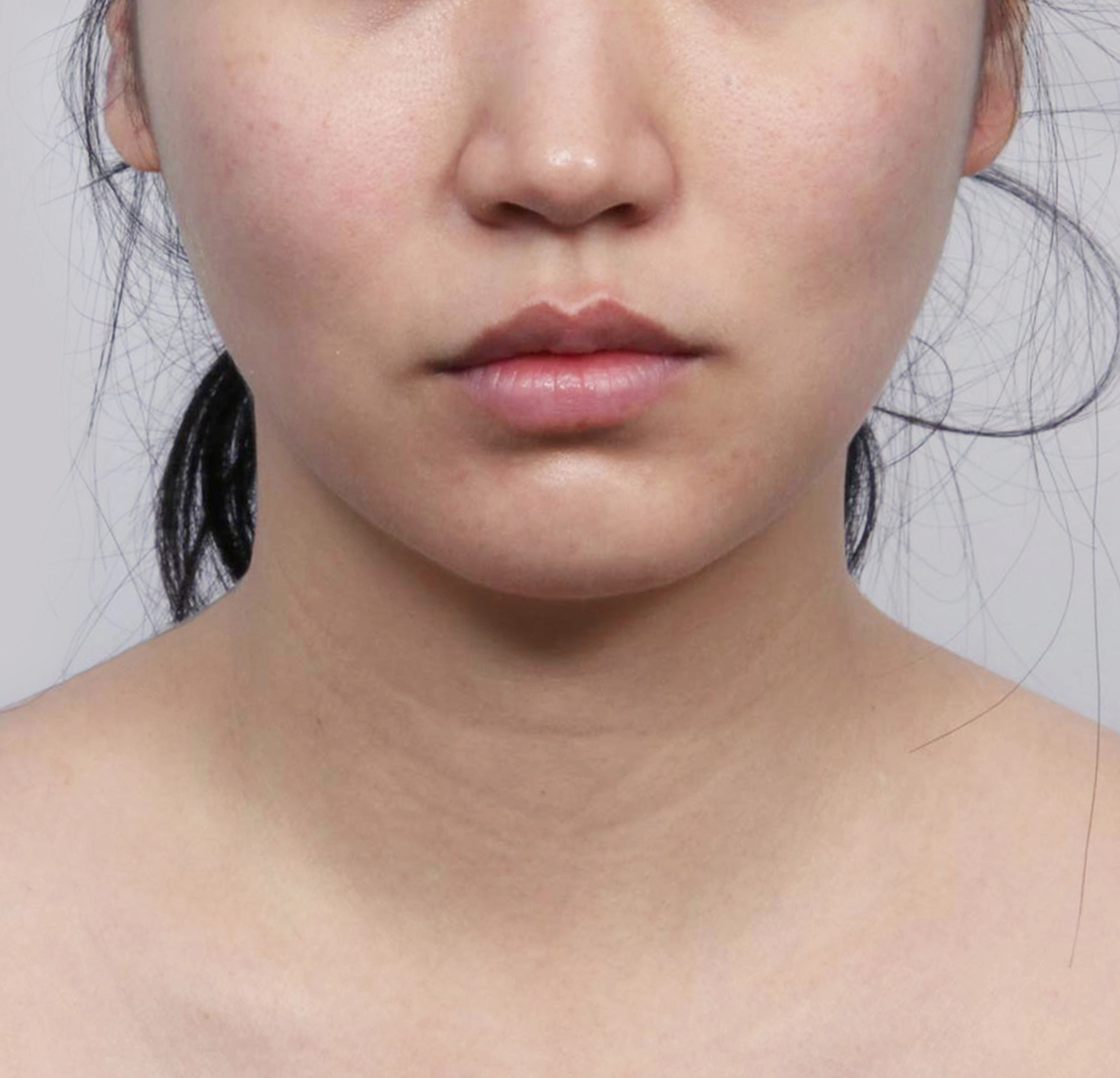 Mini Face Lift-정면-전