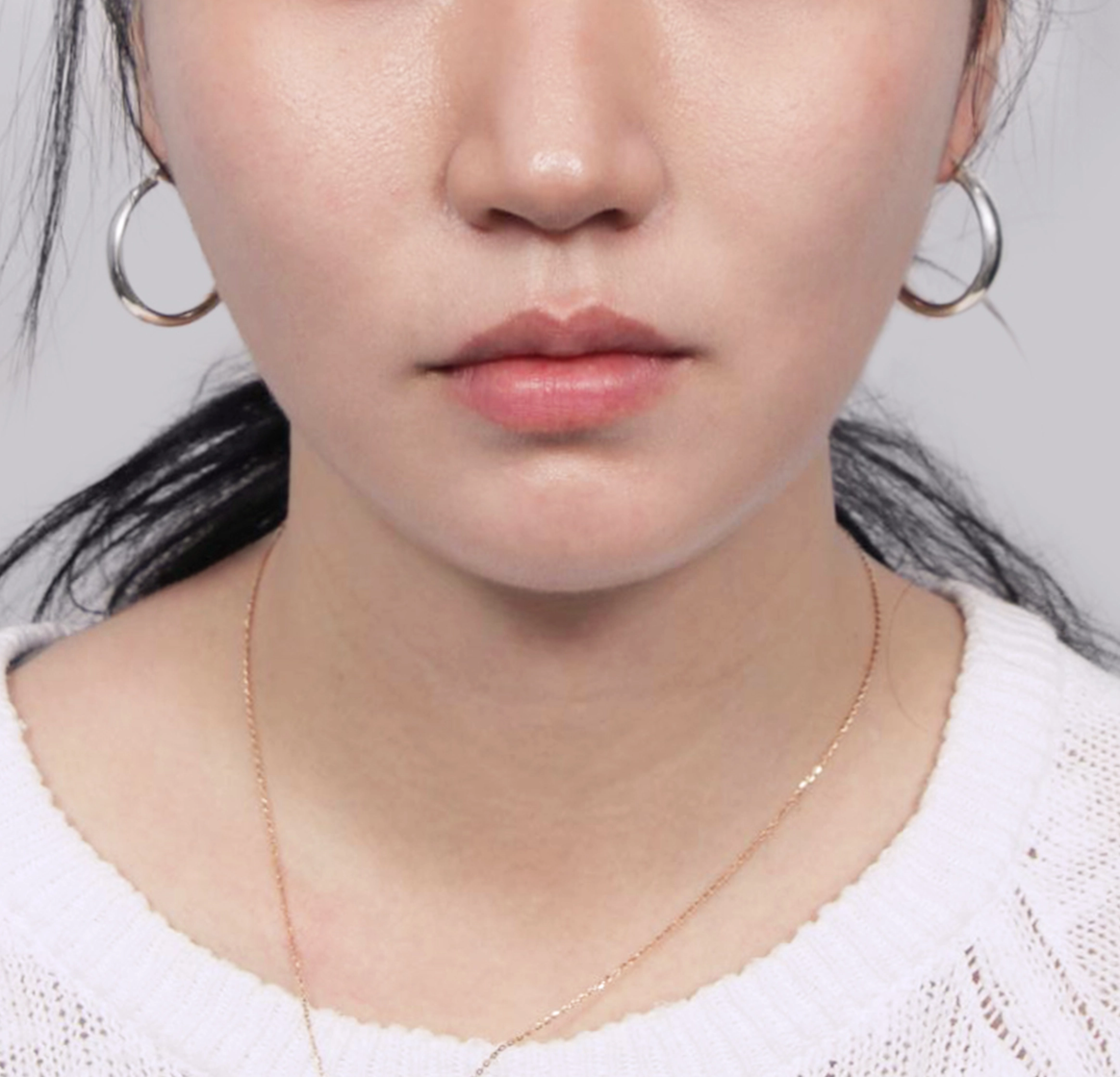 Mini Face Lift-정면-후