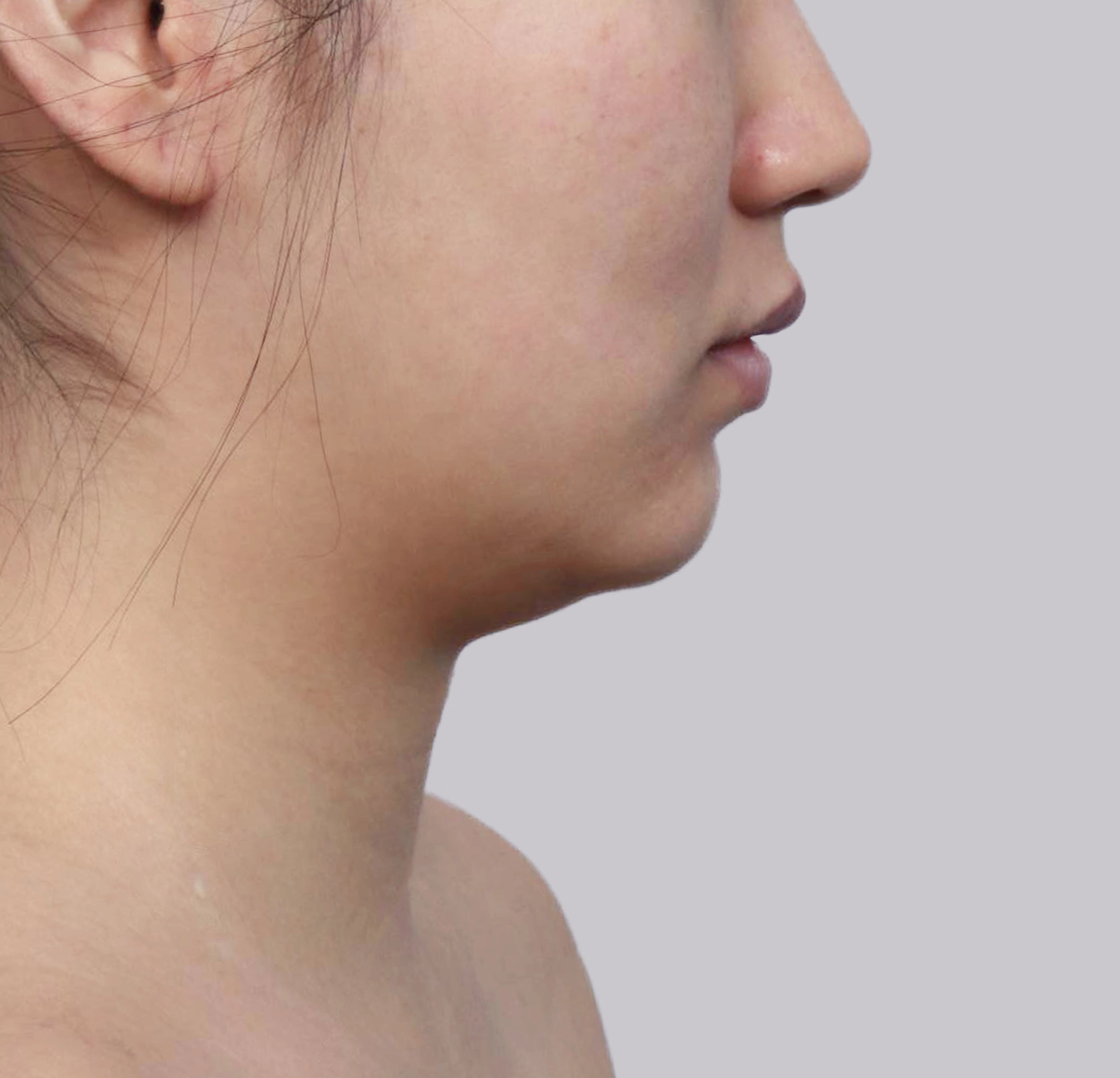 Mini Face Lift-측면-전