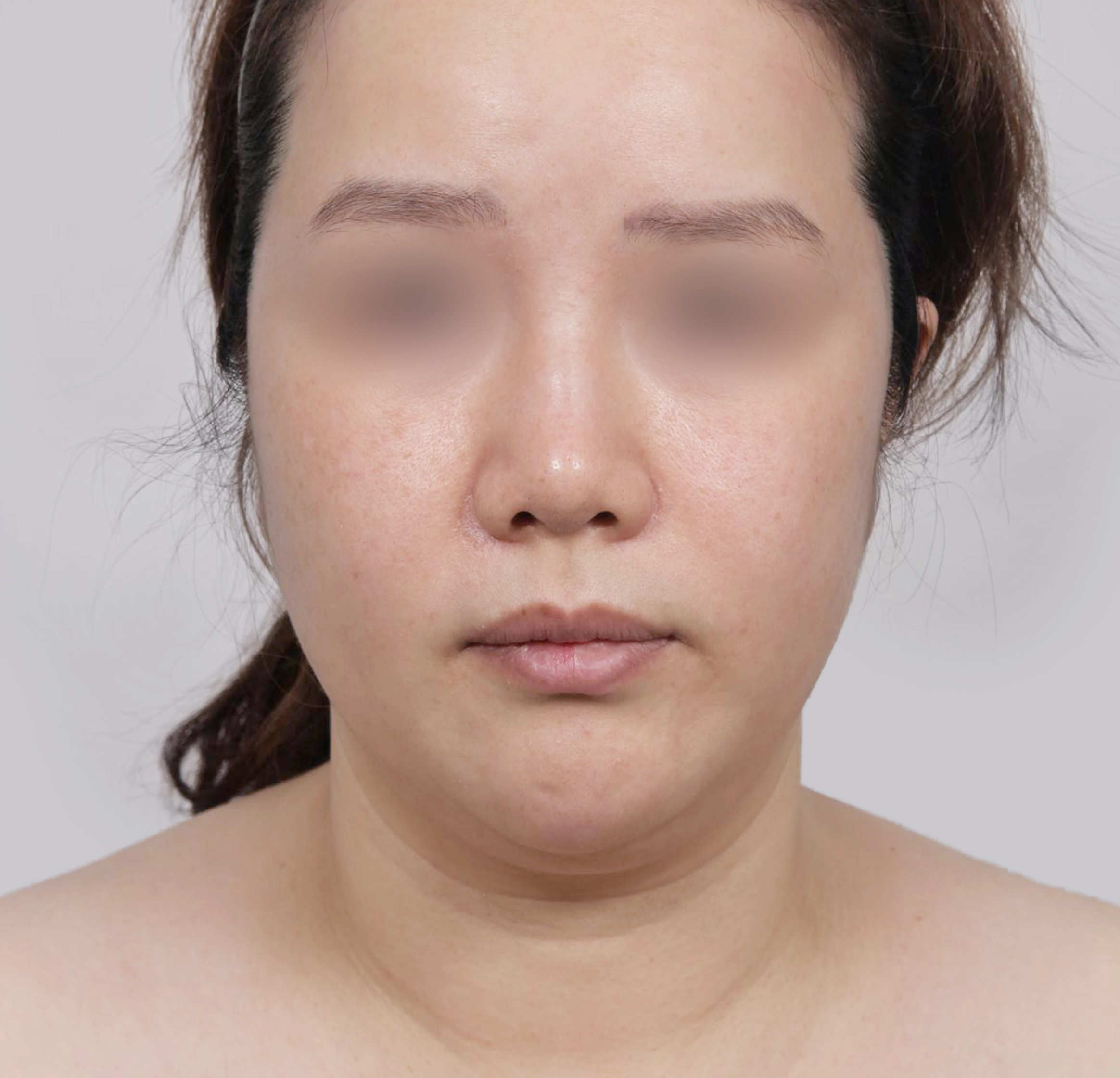 Mini Face Lift-정면-전