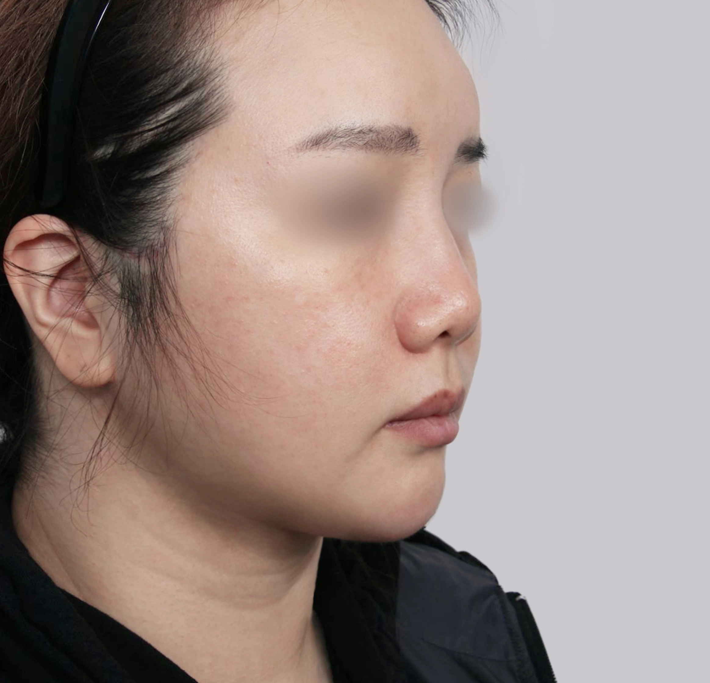 Mini Face Lift-45도-후