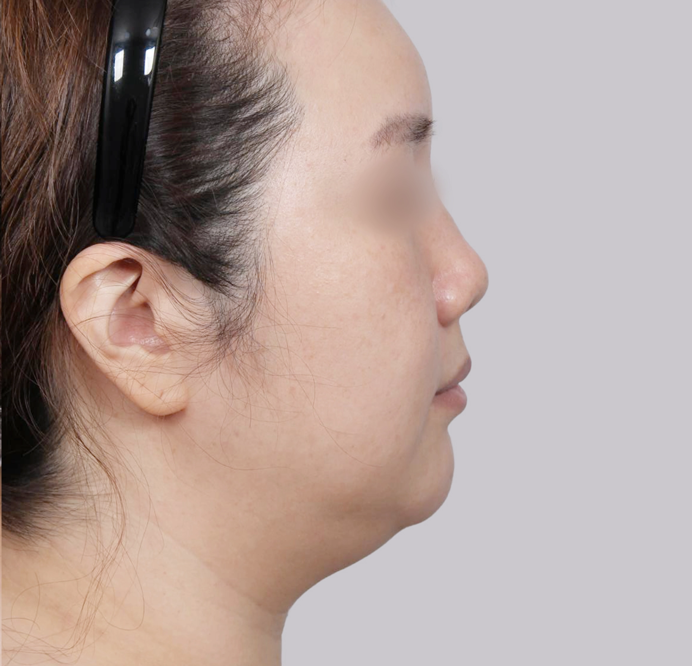 Mini Face Lift-측면-전