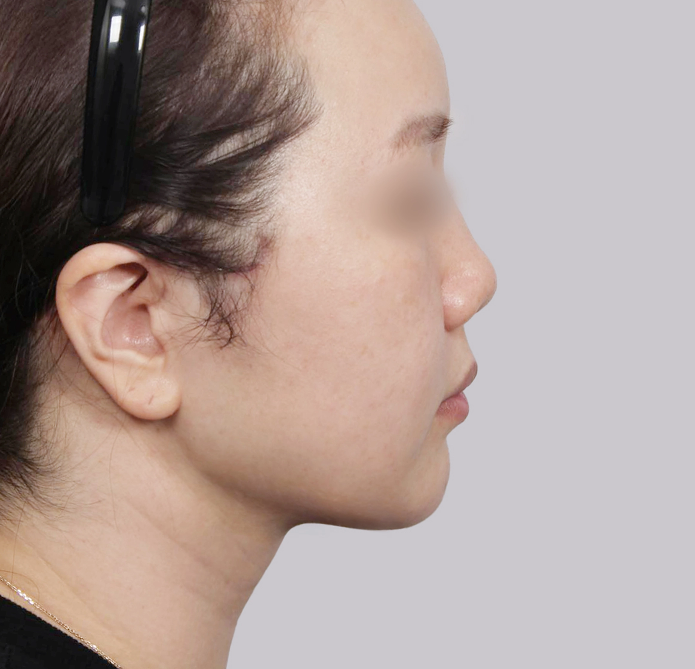 Mini Face Lift-측면-후