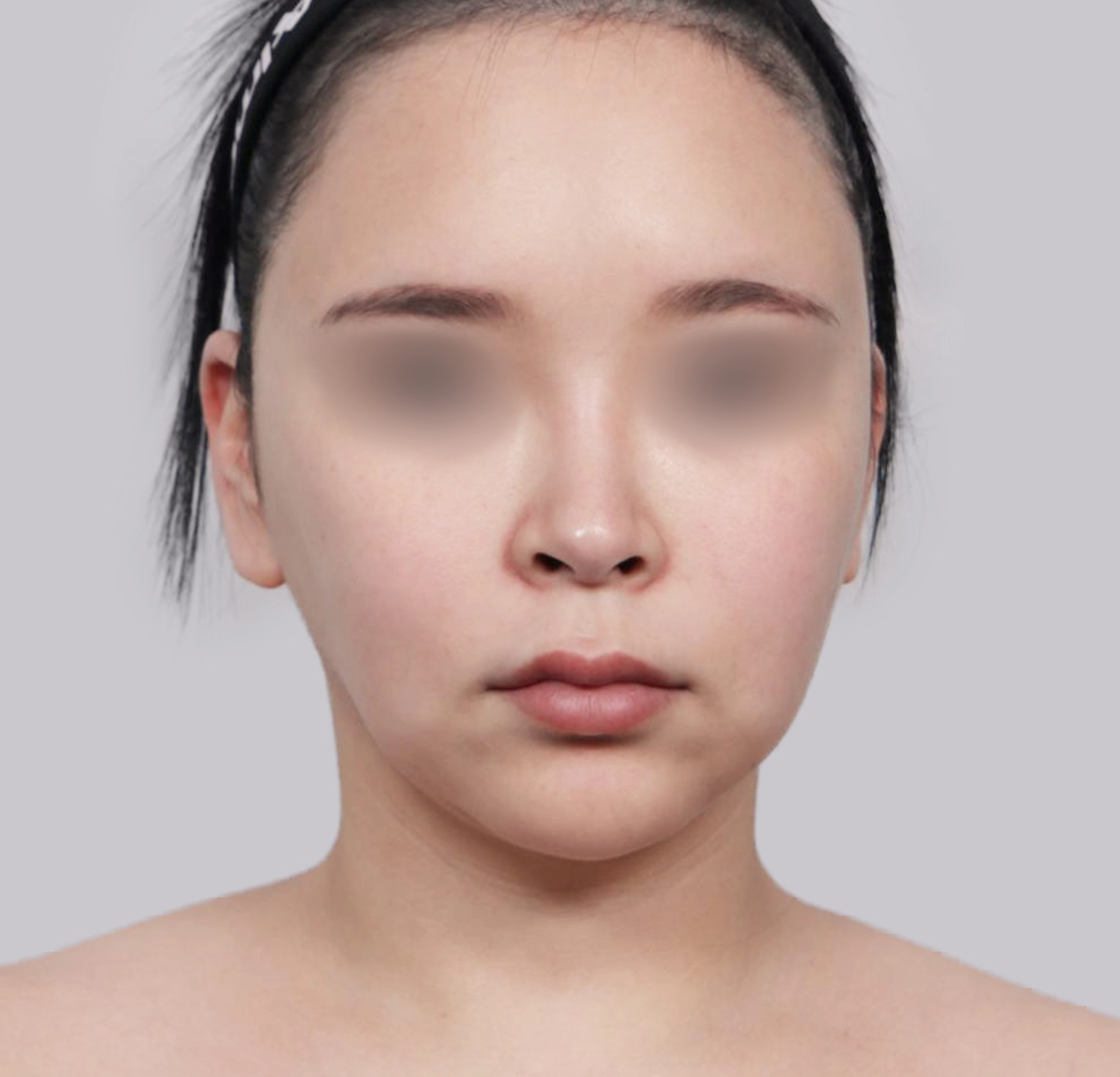 Mini Face Lift-정면-전