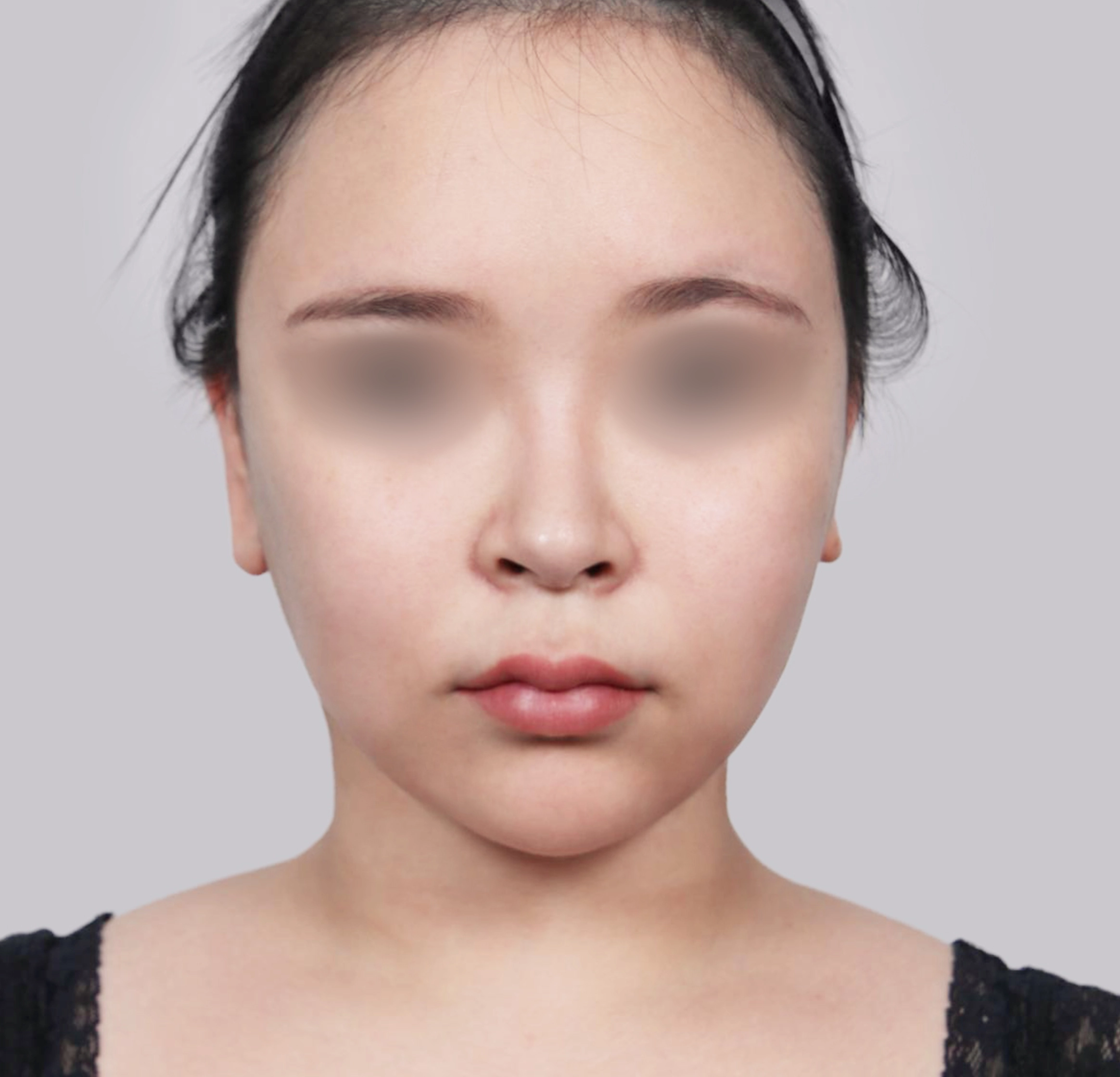 Mini Face Lift-정면-후