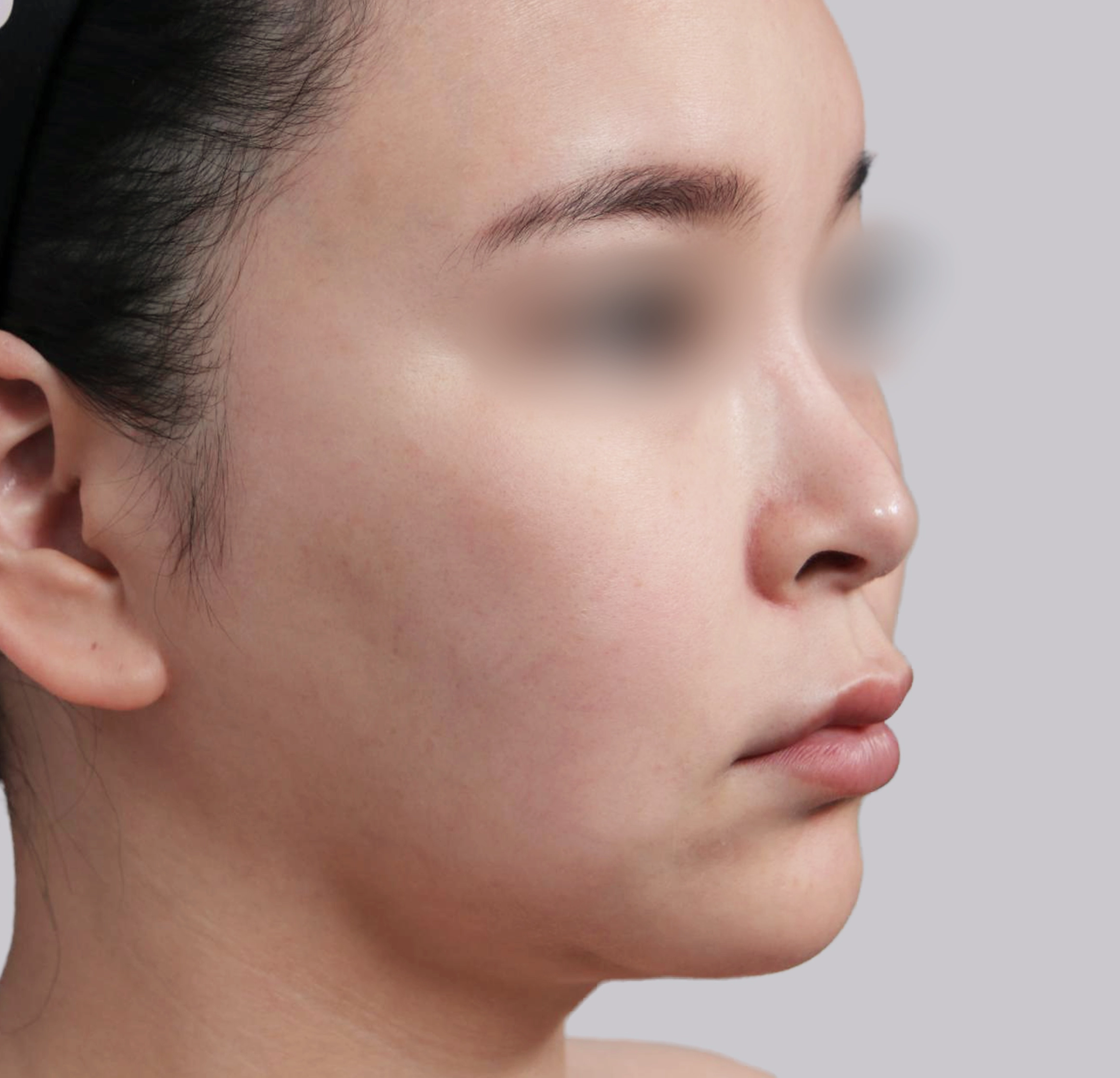 Mini Face Lift-45도-전