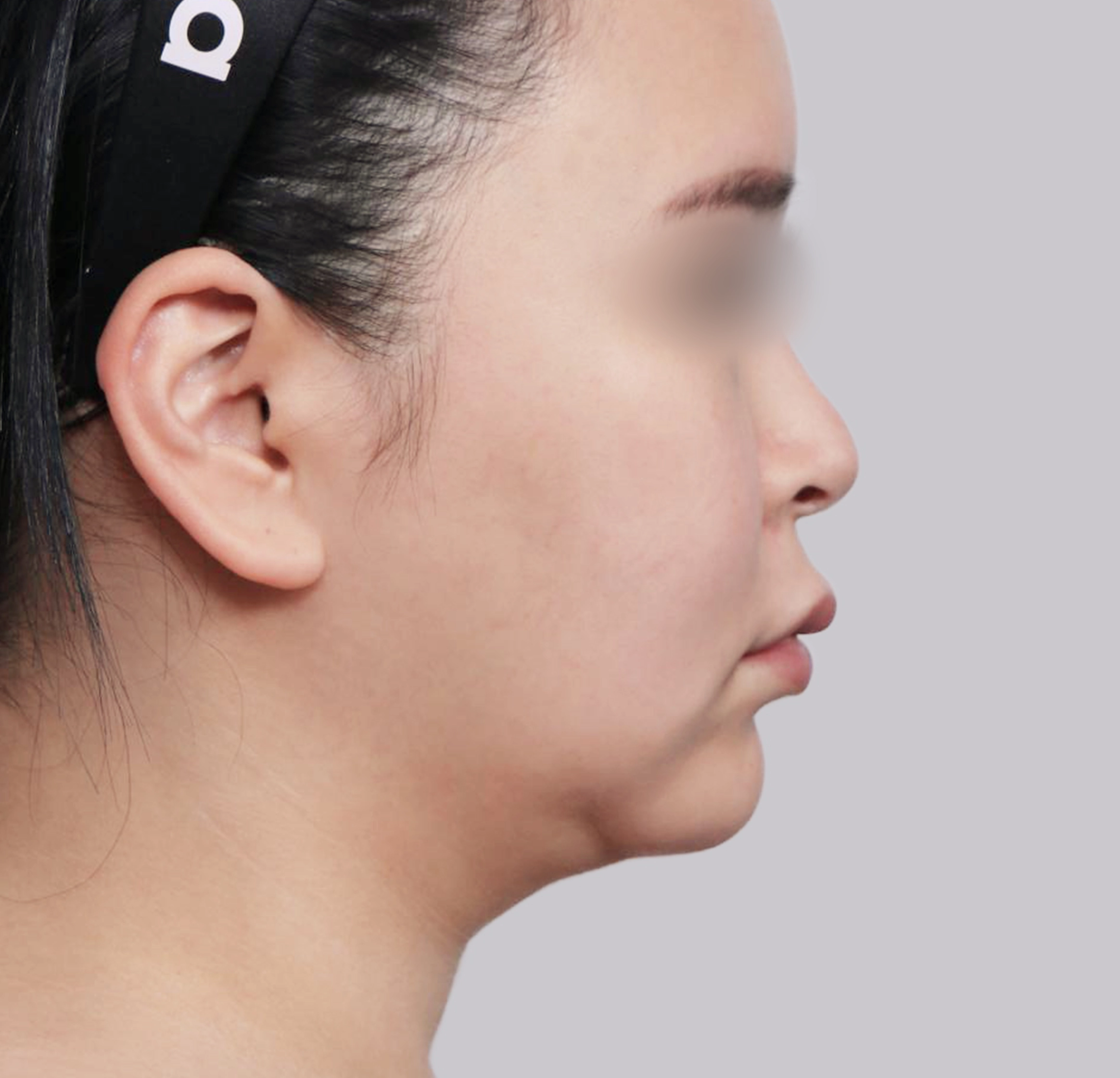 Mini Face Lift-측면-전