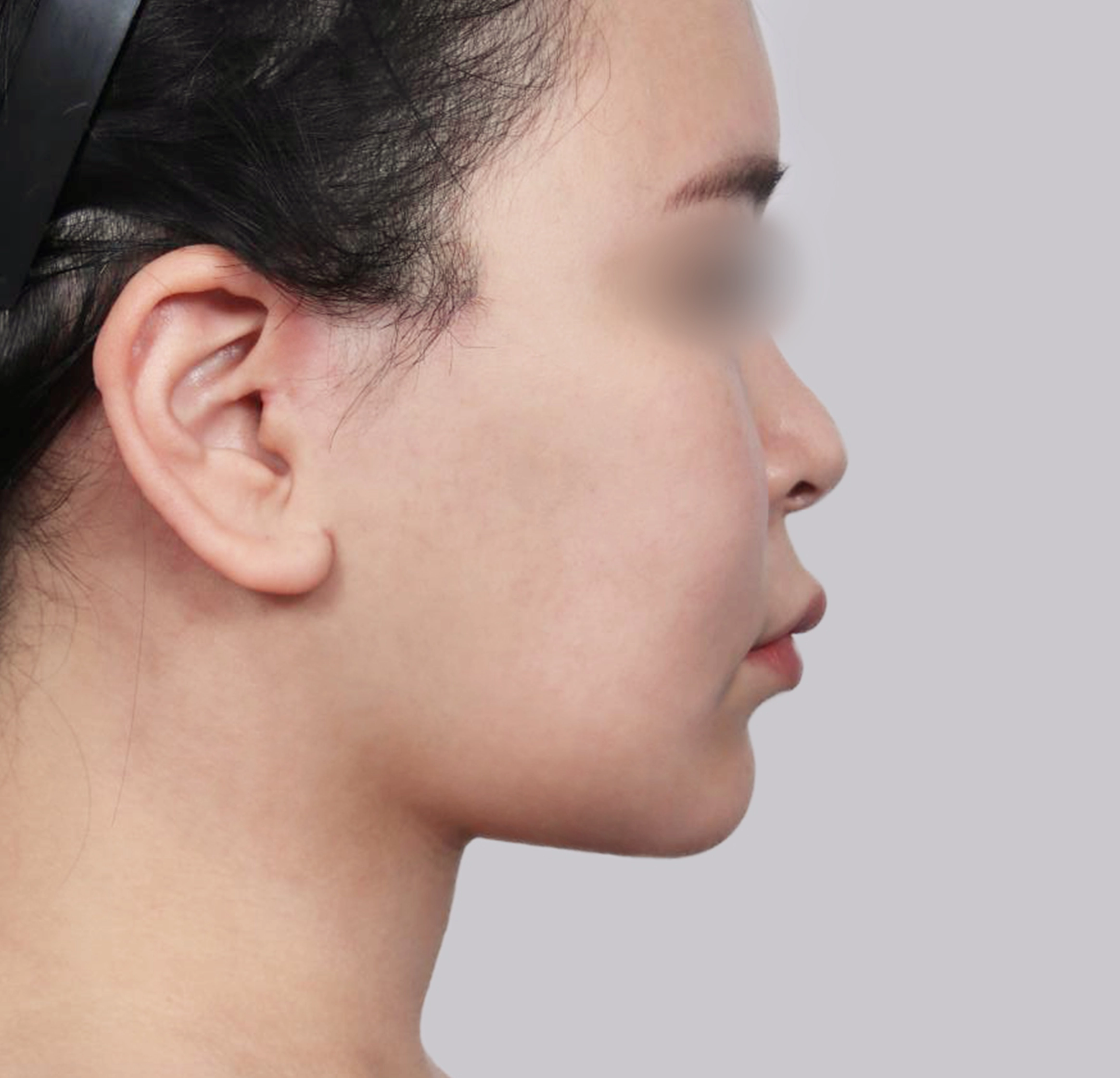 Mini Face Lift-측면-후