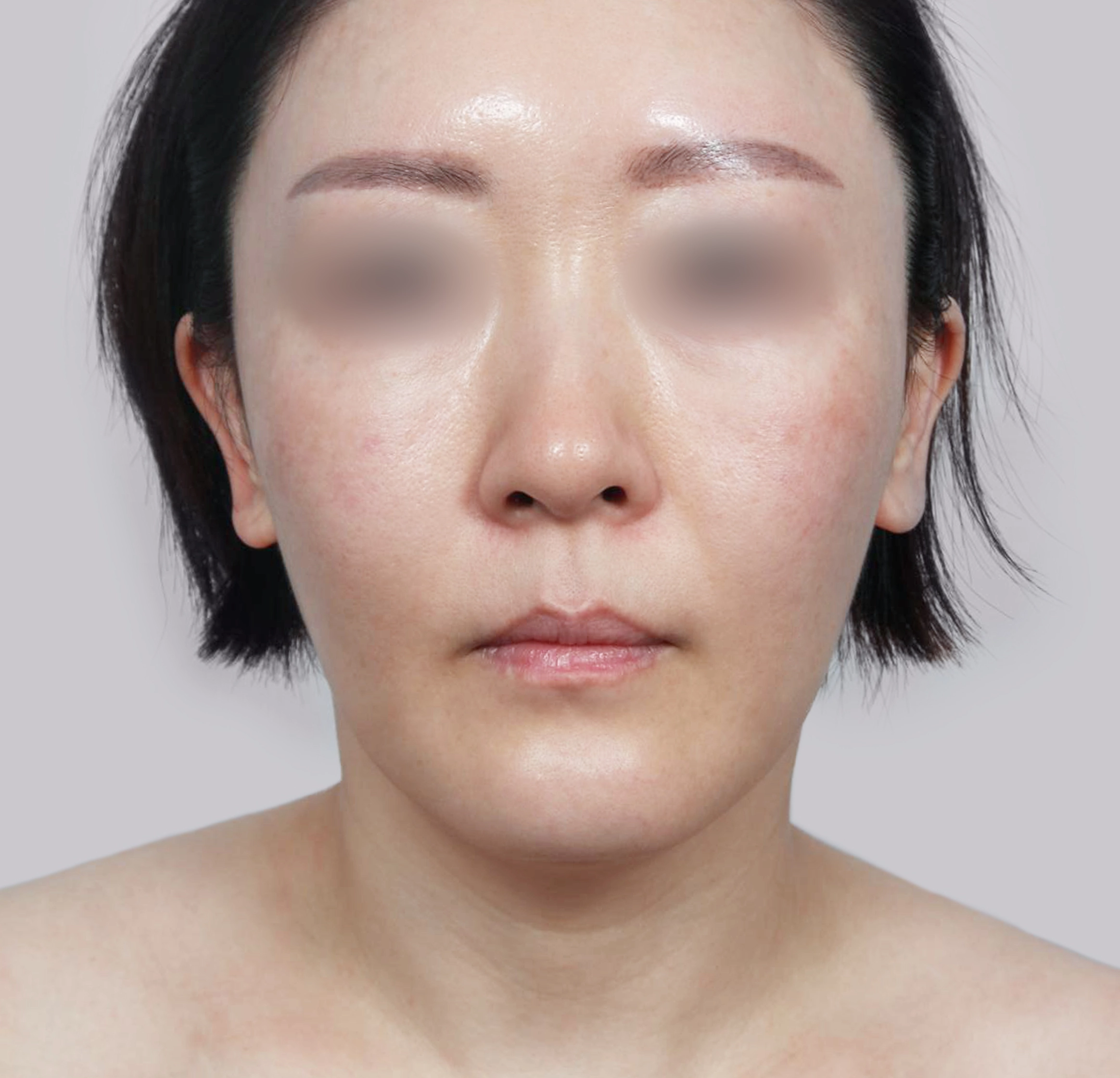 Mini Face Lift-정면-전