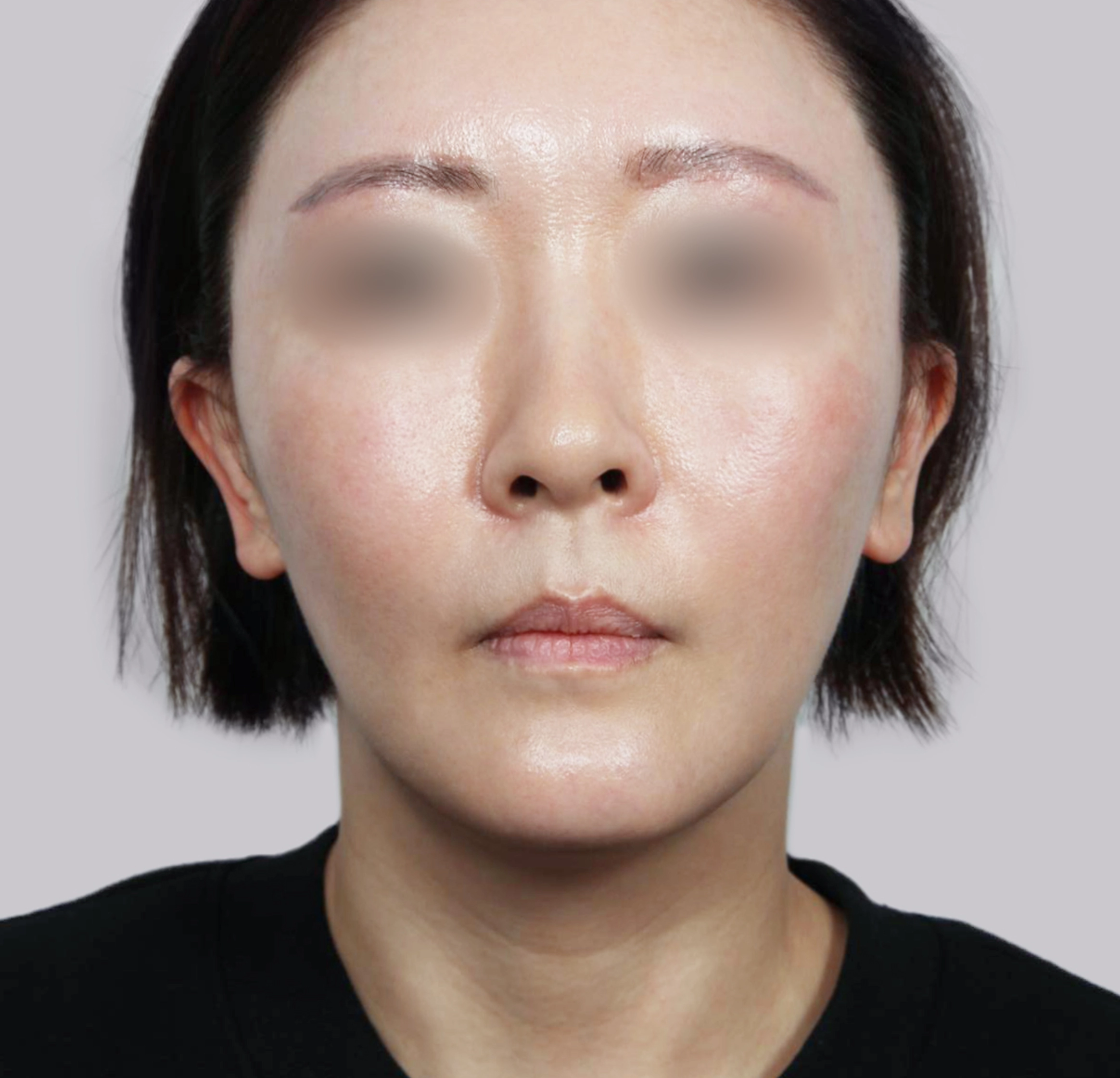 Mini Face Lift-정면-후