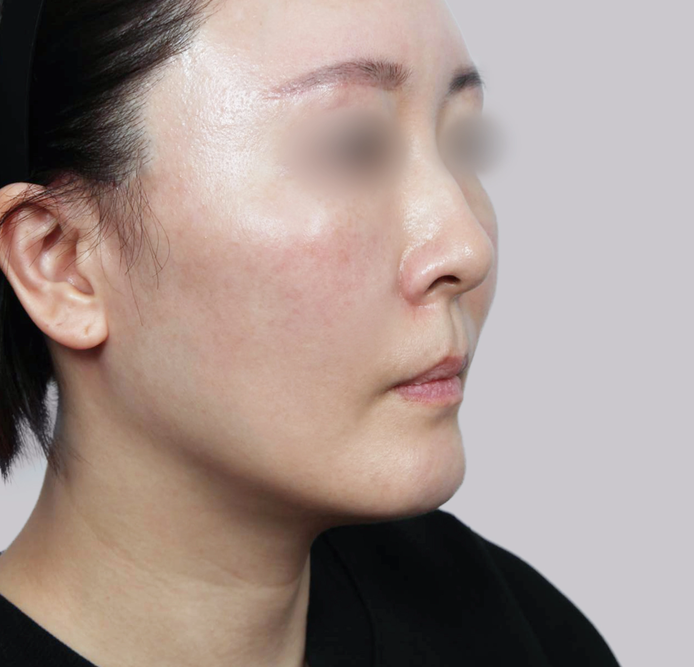 Mini Face Lift-45도-후