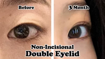 Non Incision Double Eye Surgery